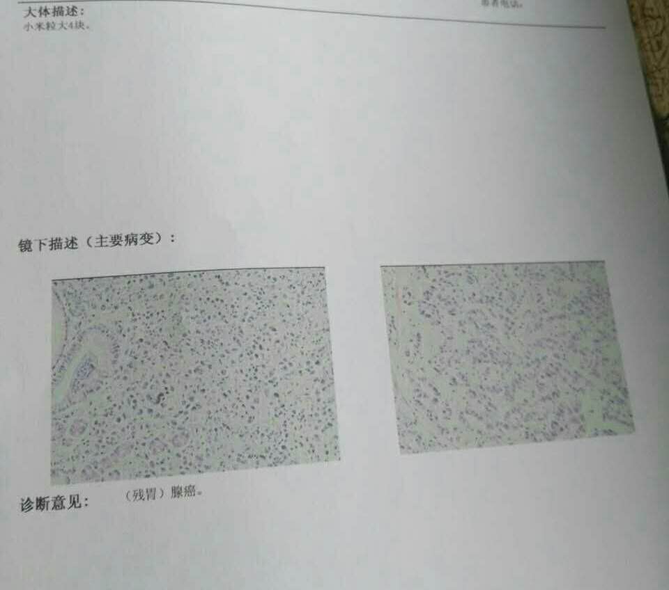 近期身體乏力，渾身沒(méi)勁，去縣醫(yī)院診斷的結(jié)果是（殘胃）腺癌，小