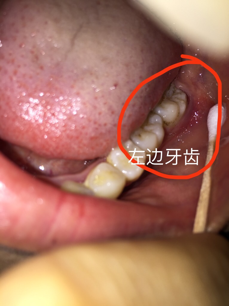左边牙龈三周前发炎红肿,现在消肿之后扒开发现牙龈和牙齿分开了
