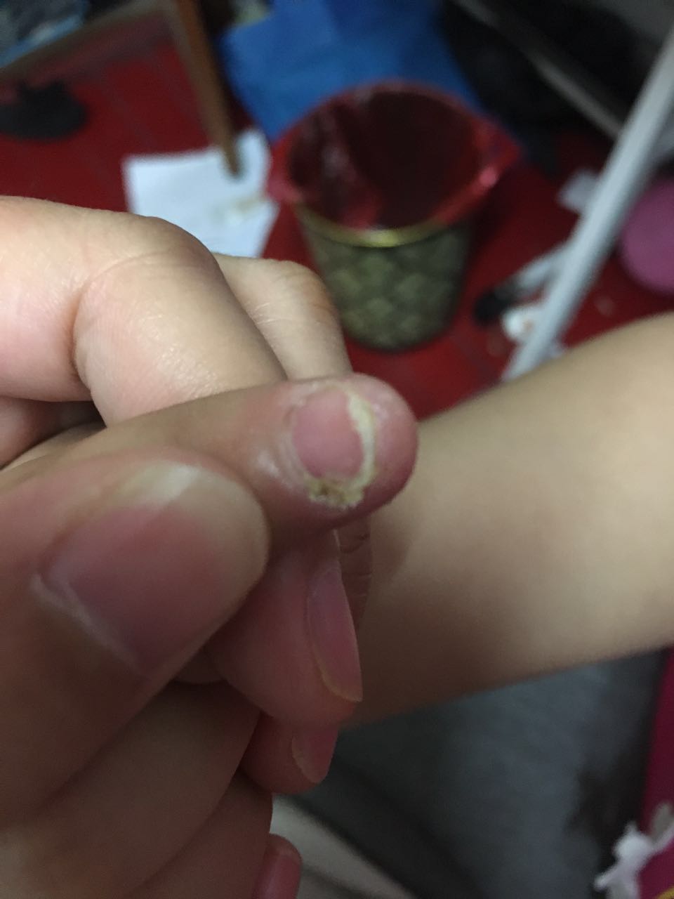 一个5岁小孩手指得了真菌感染怎么办,指甲盖有些像灰指甲,指甲