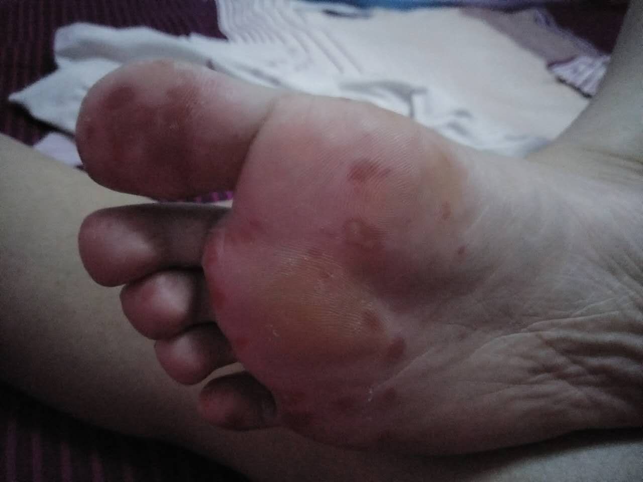 请看图片脚底不知道是脚气还是什么疼用花椒水泡了两天不