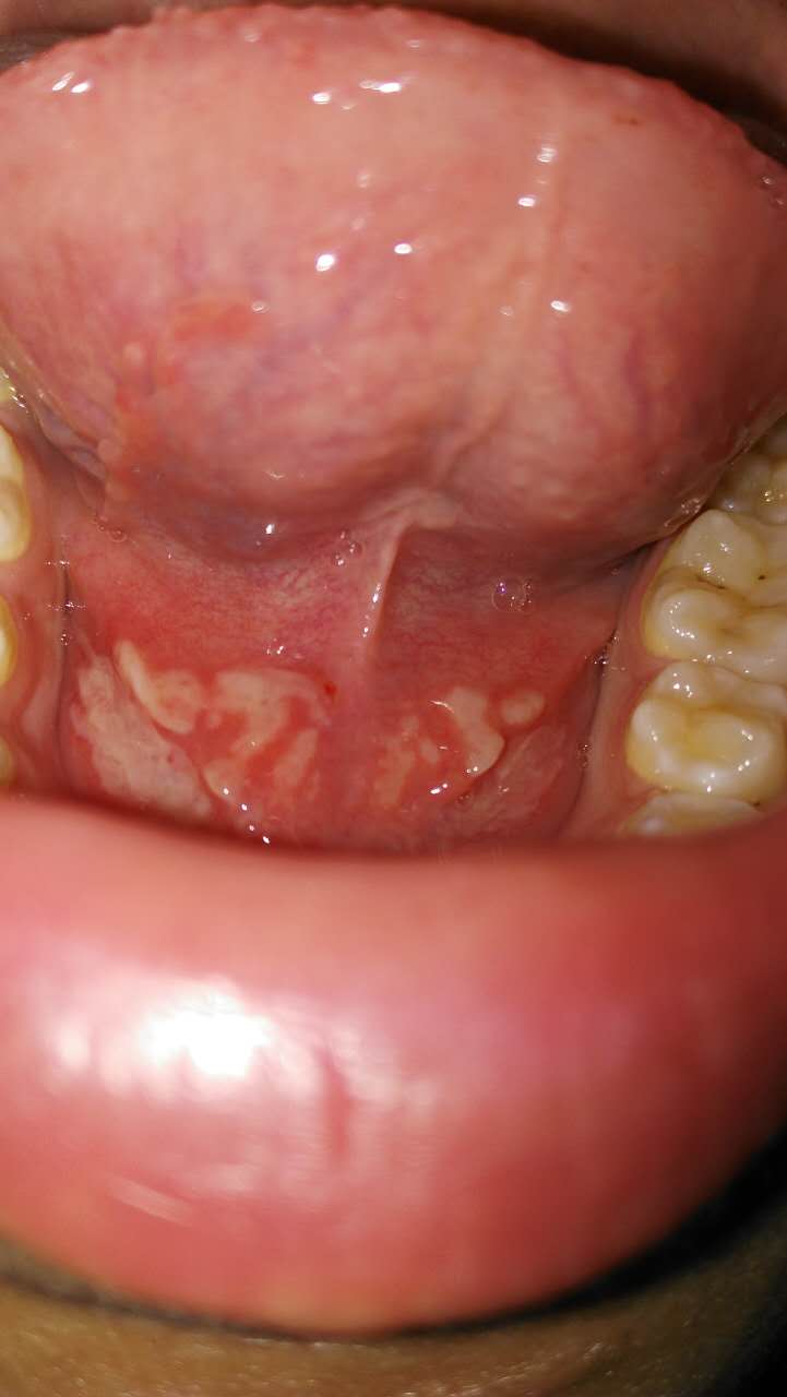 口腔溃疡,舌头下面大面积白色,舌头侧面有白泡,有疼痛