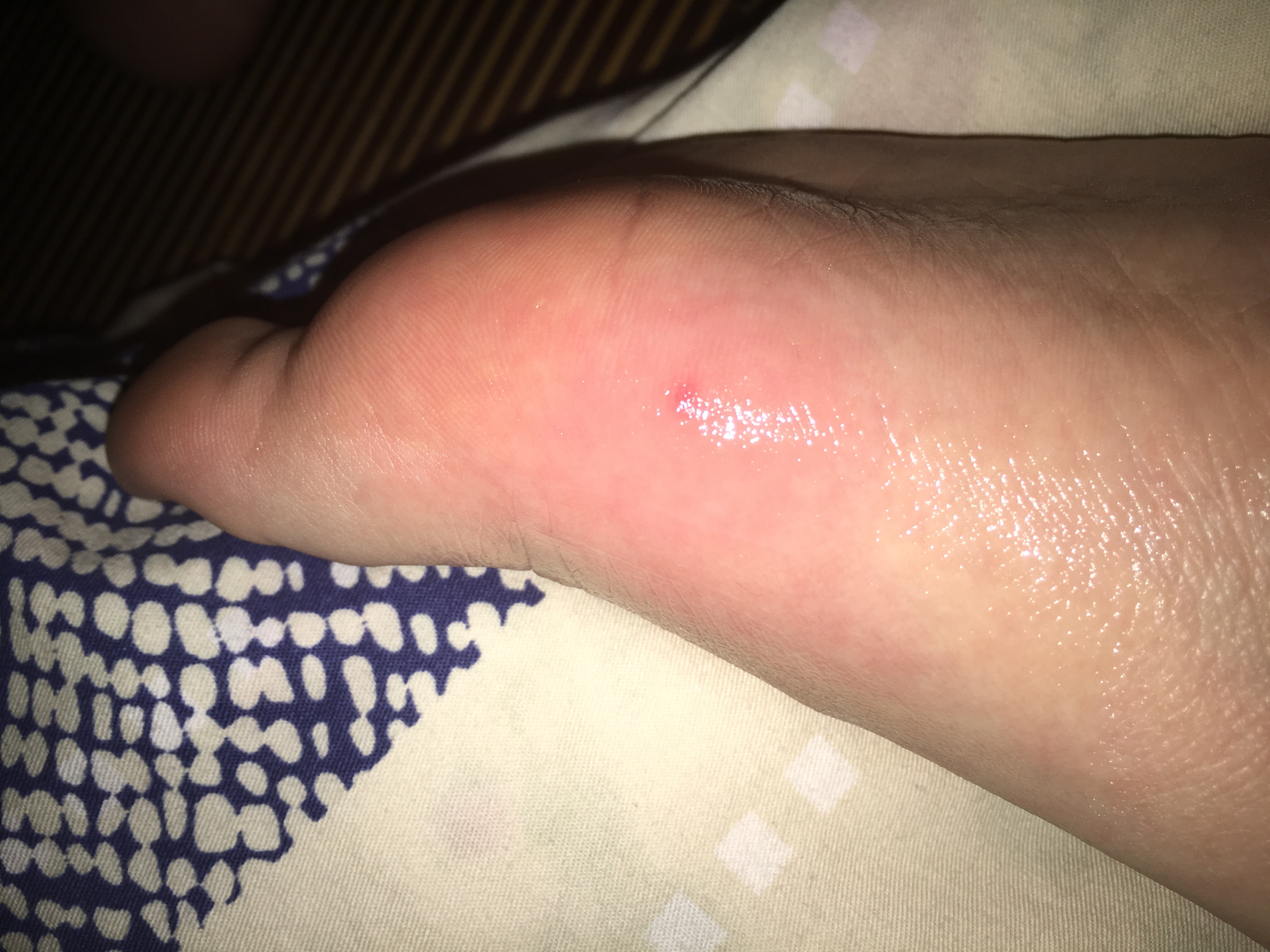 前天被蚊子咬脚底后,今天出现疼痛肿淤血痒.只有中间疼,旁边没