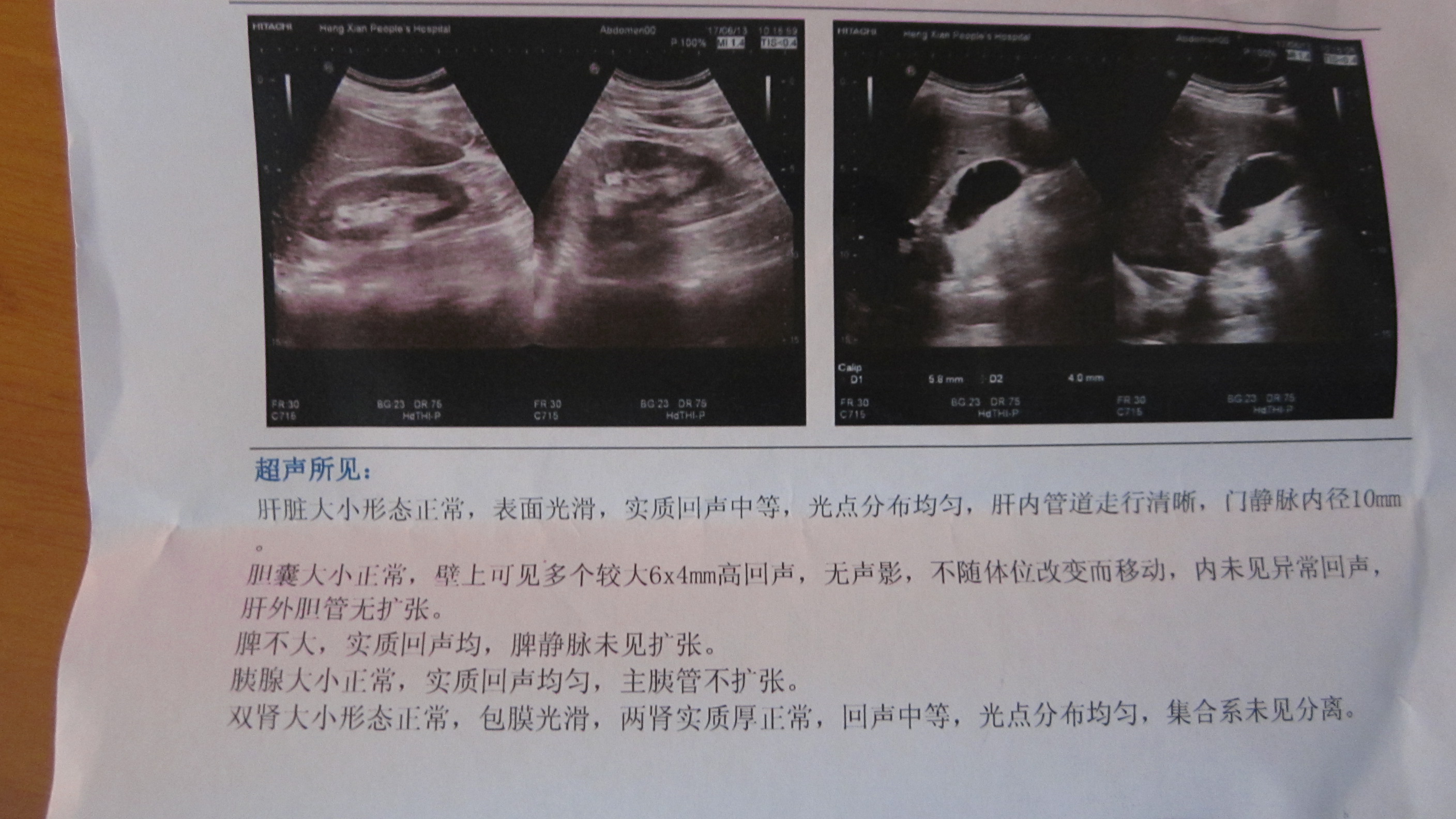 右胁下隐隐痛.彩超说有胆囊息肉,顺便帮我看下化验单.丙胺酸胺