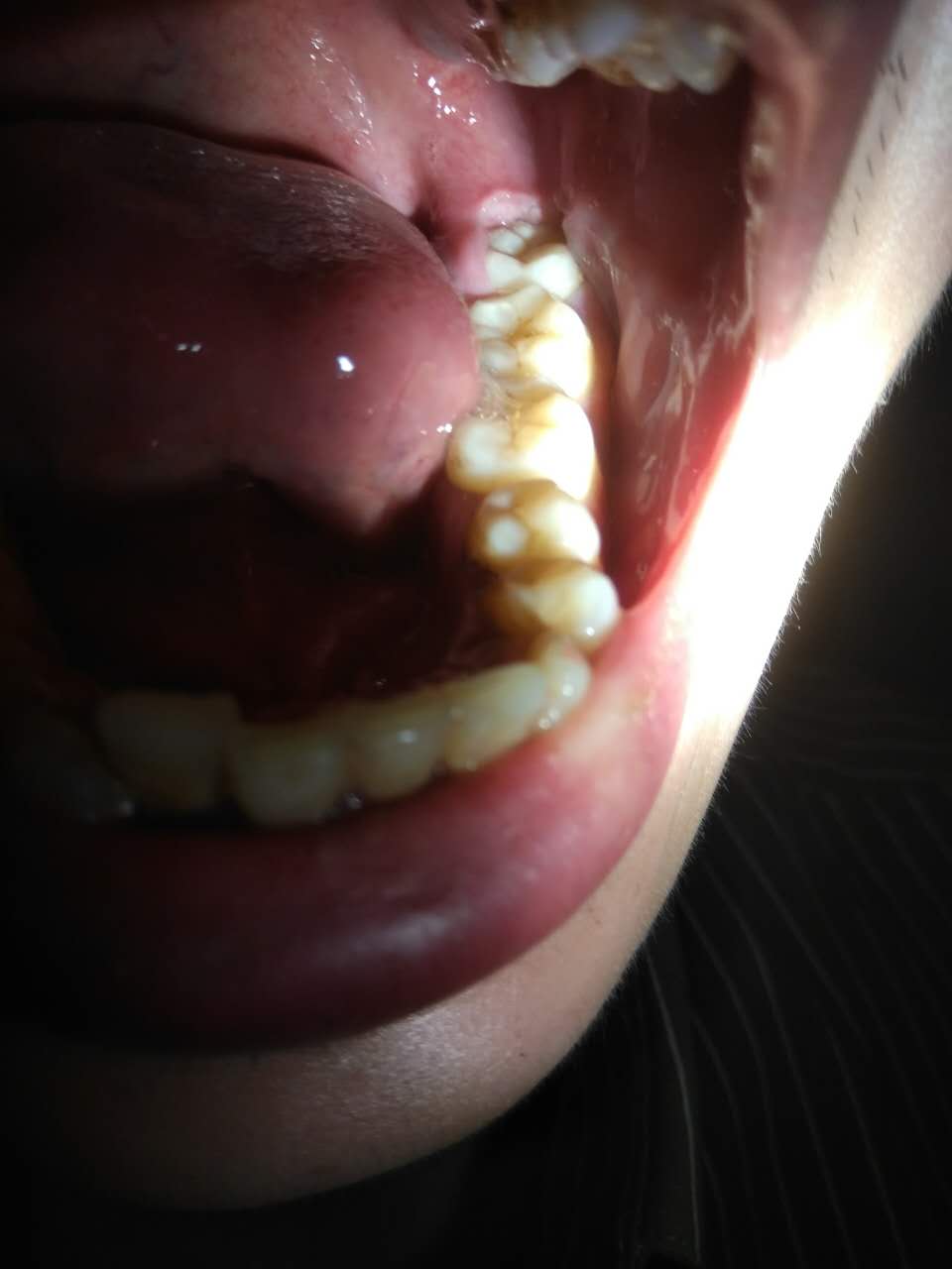 牙齿最后面的肉肿痛图