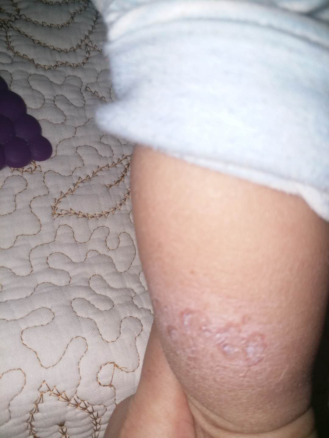 宝宝腿上说是湿疹,结果用了炉甘石,感觉严重了,麻烦看看,这是