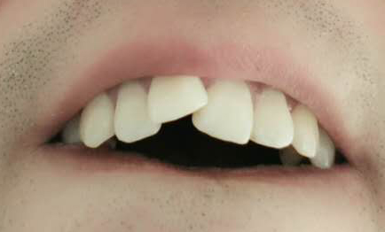 求牙医正畸专家看看30岁男小时候摔了一跤导致的,一颗门牙翘起