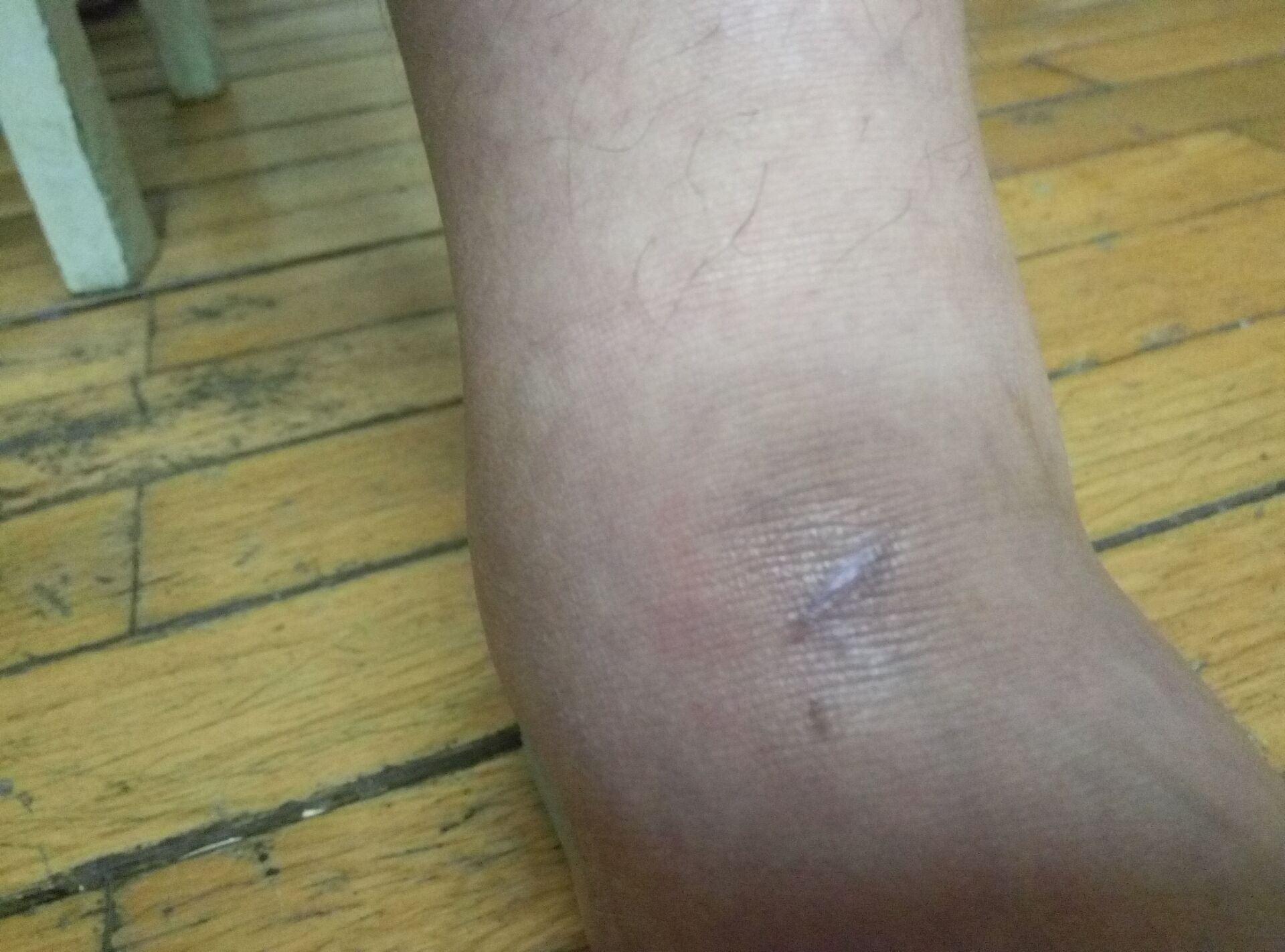 左脚脚踝割伤伤口已愈合近两个月最近几天发现伤口周围浮肿