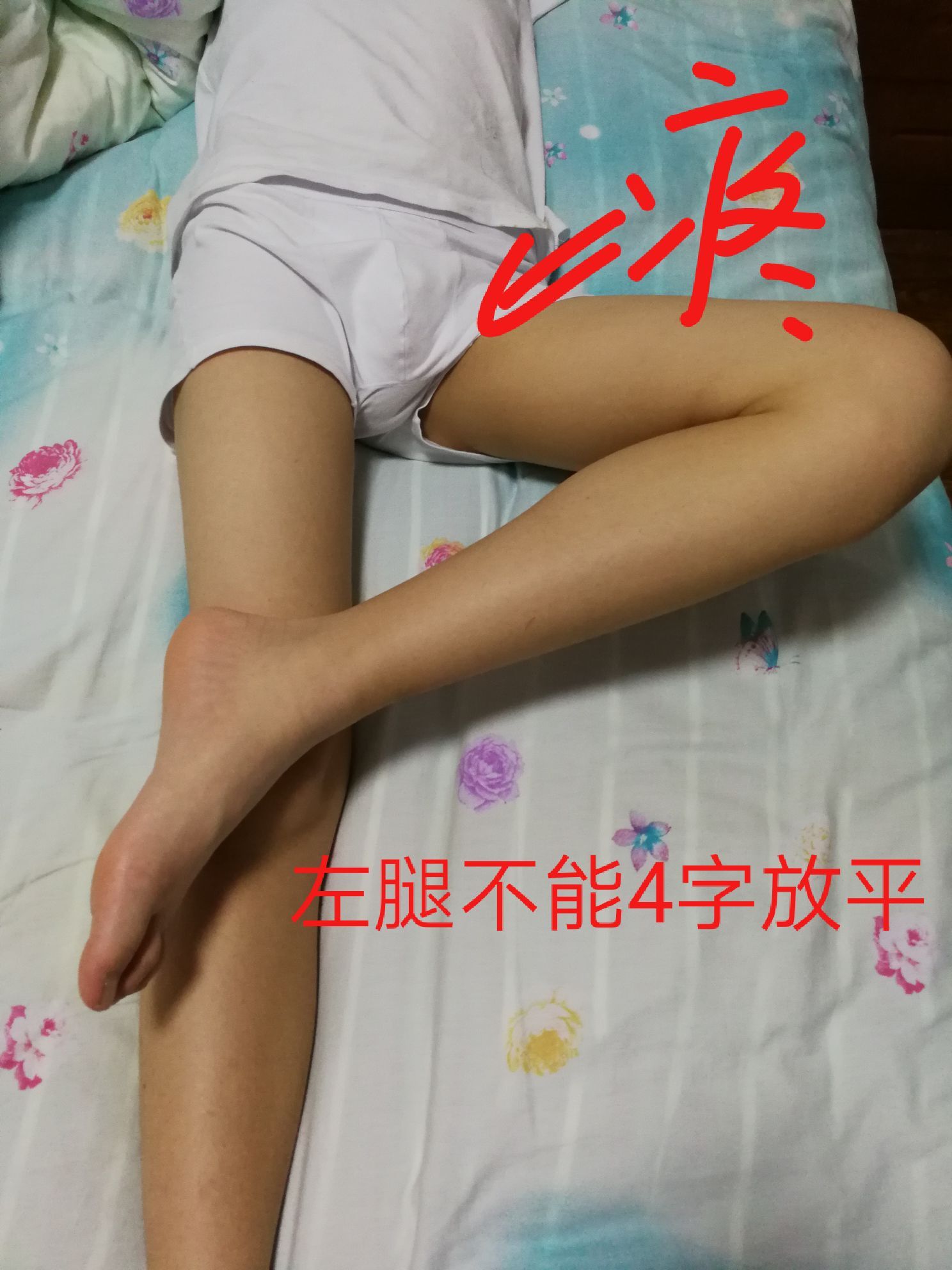 我儿子13周岁,下面的腿部照片,像k形腿,小时候走路内八字