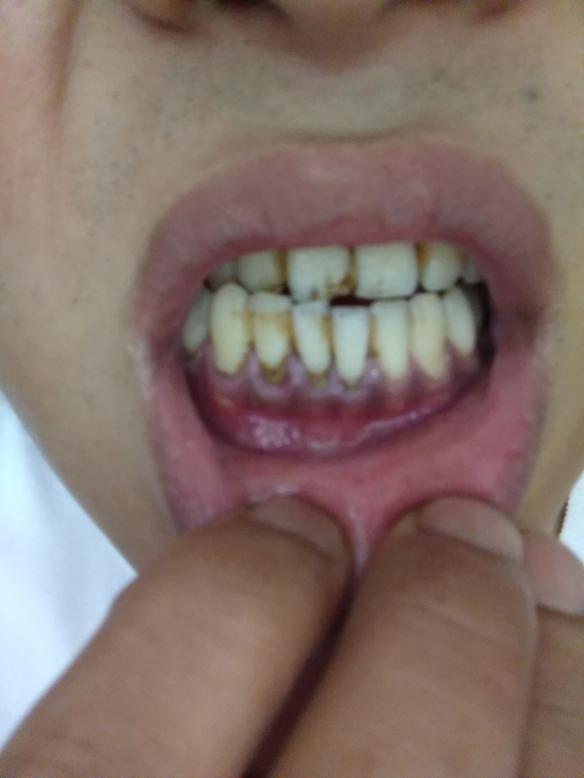 我的牙齿下方黑黑的是结石吗,需要做龈下刮治吗还是单纯的洗牙就