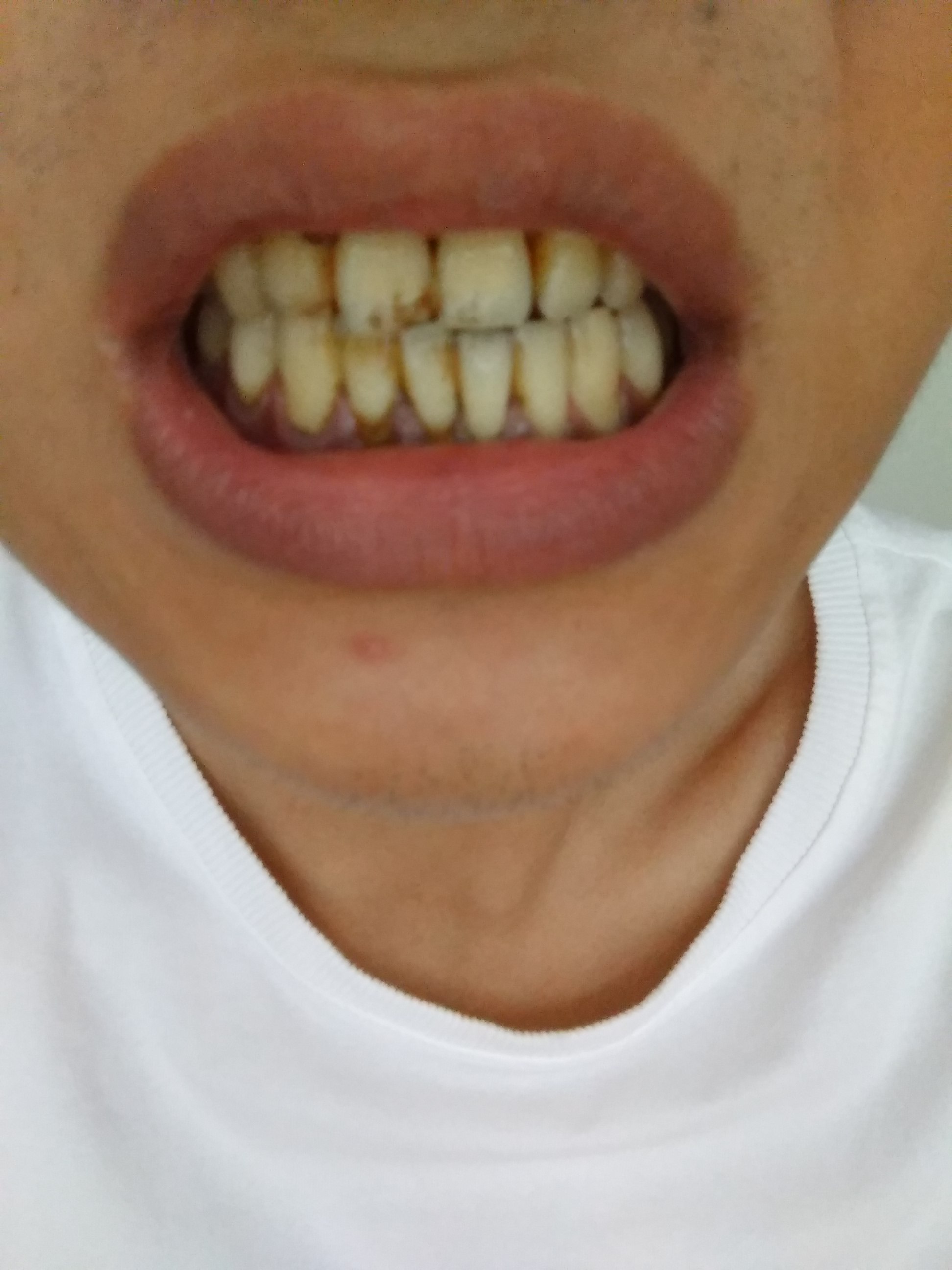 我的牙齿下方黑黑的是结石吗需要做龈下刮治吗还是单纯的洗牙就