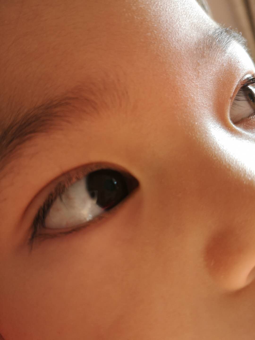 4岁半儿童眼睛有红血丝10天了,开始眼睛流泪眼干,用了