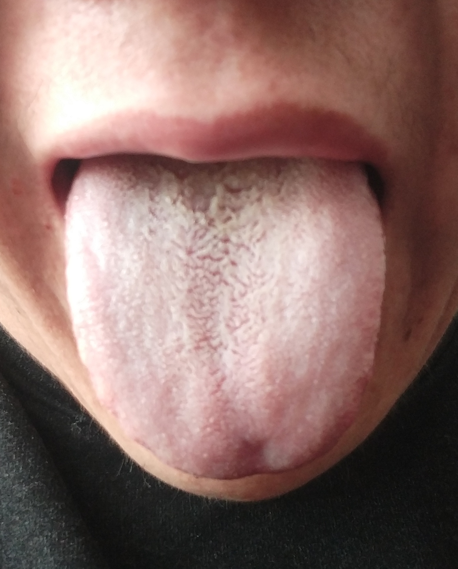 最近发现舌头上长满了白毛,会是hiv千兆吗?