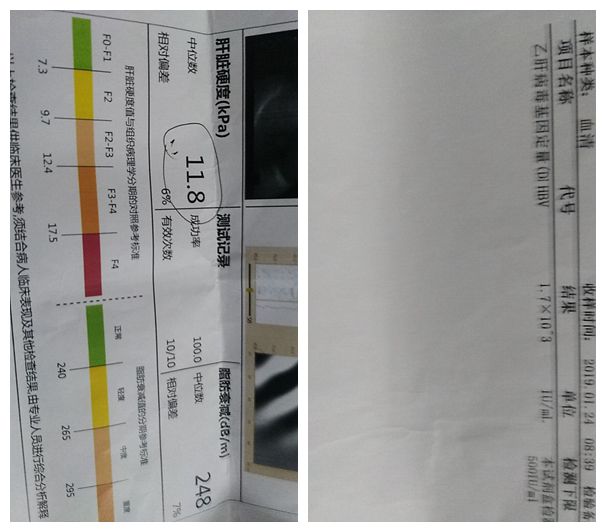 男，45周歲，患乙肝28年，被傳染。一直在吃中藥治療。