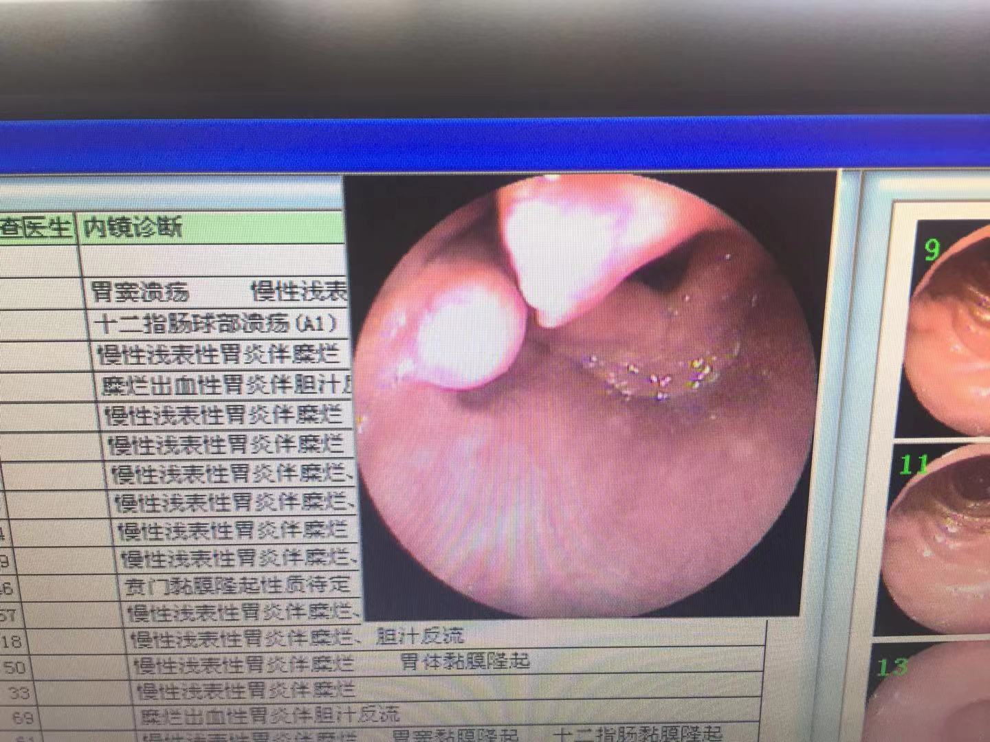 胃镜检查发现喉咙中有一肿块,外表清楚光滑,3年前胃镜