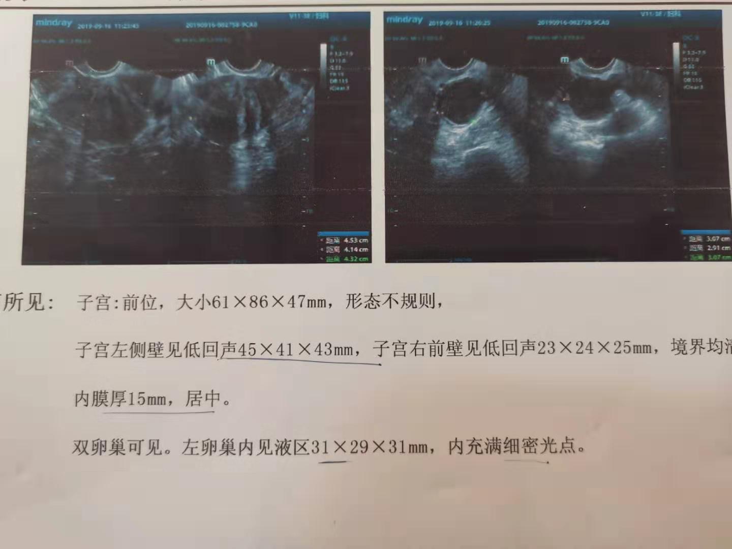 女31周歲未婚未育（無懷孕流產(chǎn)史）子宮肌瘤（左側壁、右前壁）