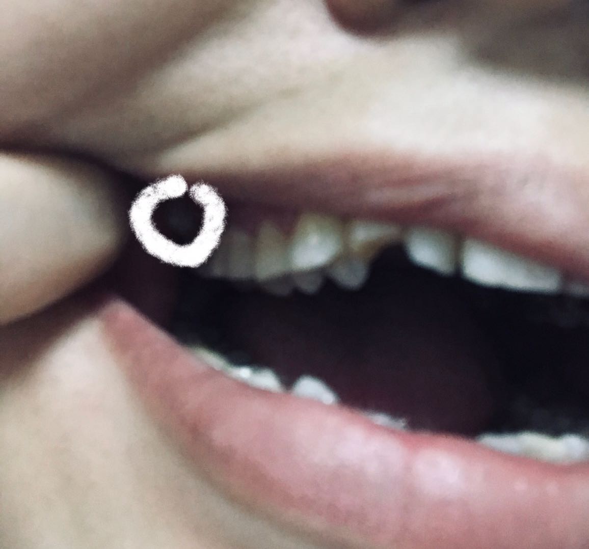 最后一颗大牙长的特别倾斜图上圈出来的就是长歪的大牙位置