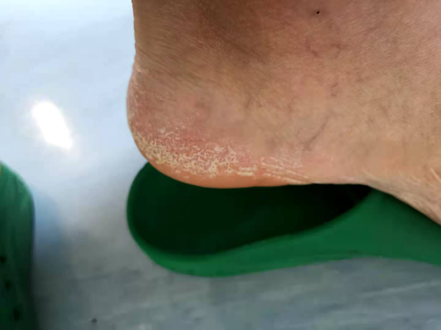 脚癣5年余,脚部真菌感染,脚容易出汗,有脚臭