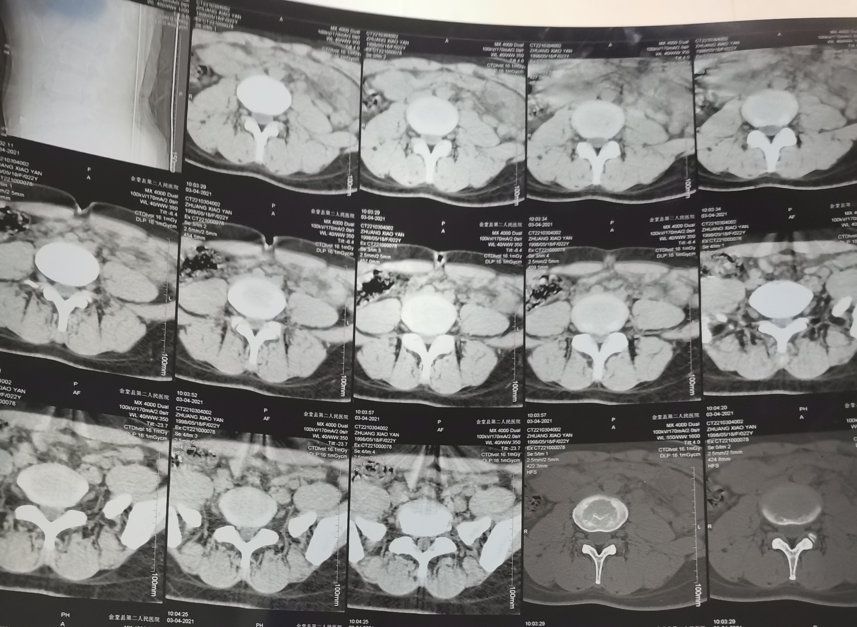 醫(yī)生就說了是L4-5膨出，但是也并沒有指出CT照里面是哪里不