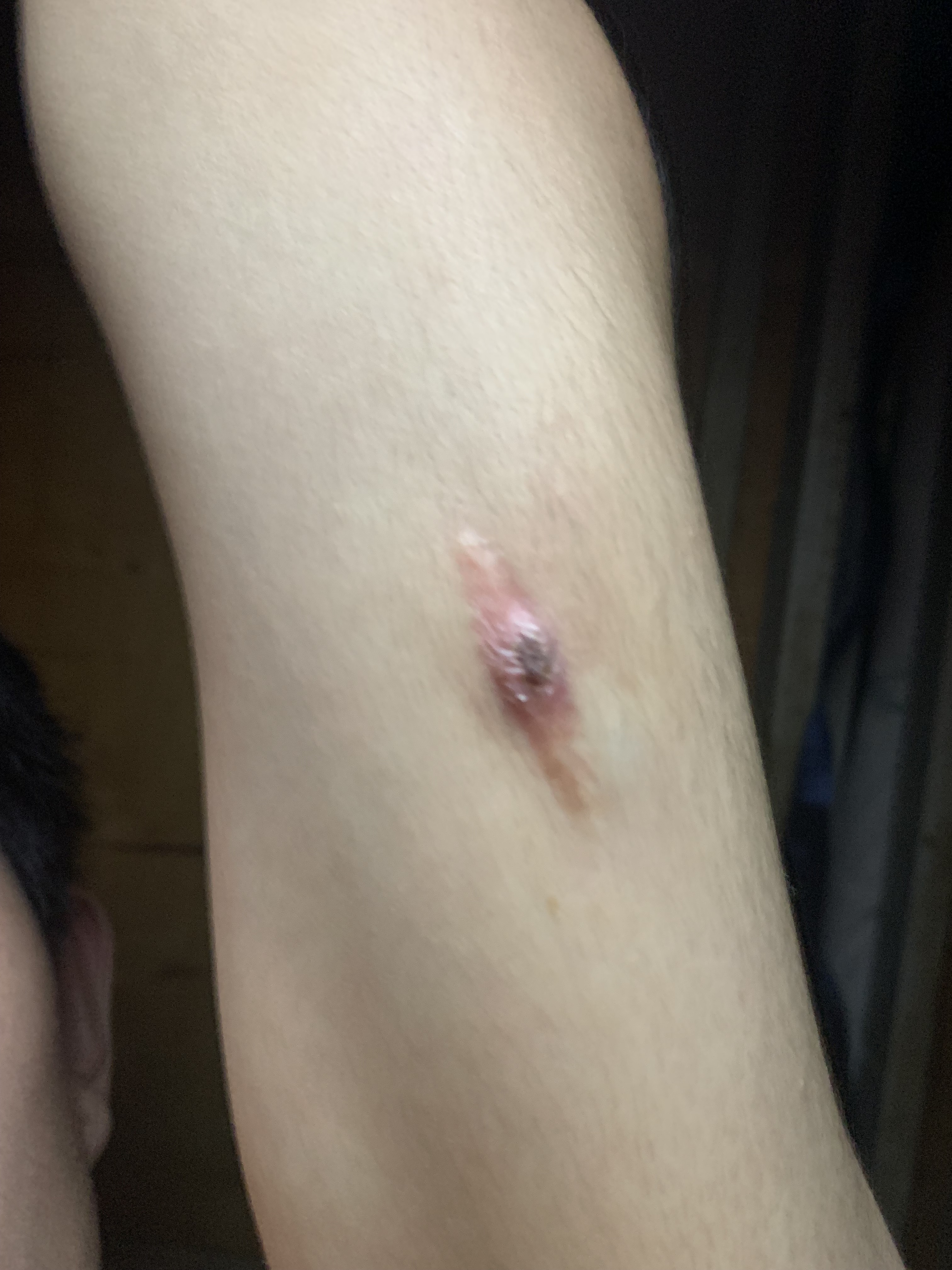 我的左臂手术两年后在我的手术疤痕处有一个小洞流出白色脓状