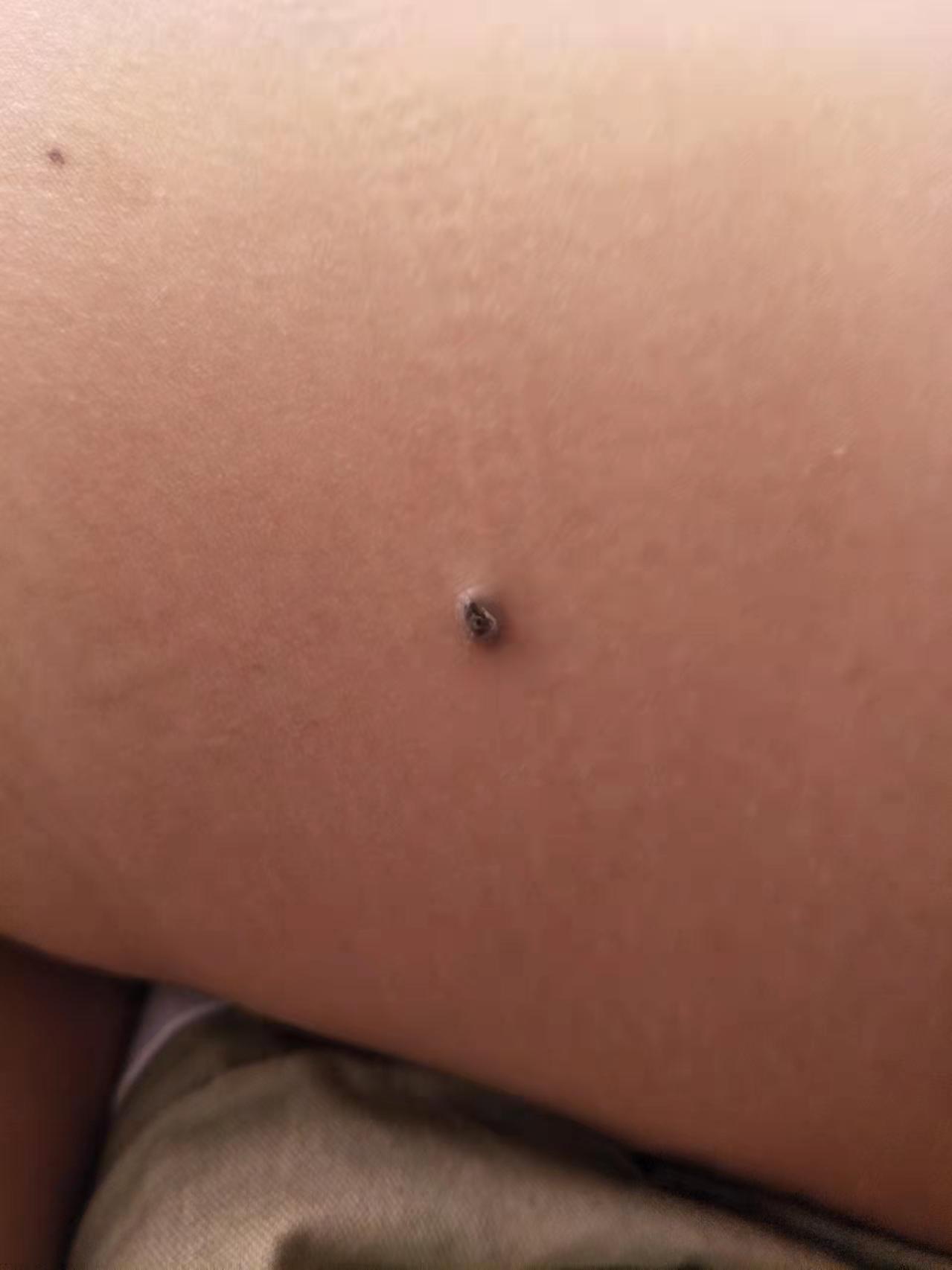 長(zhǎng)在大腿外側(cè)，好多年了，不痛不癢的