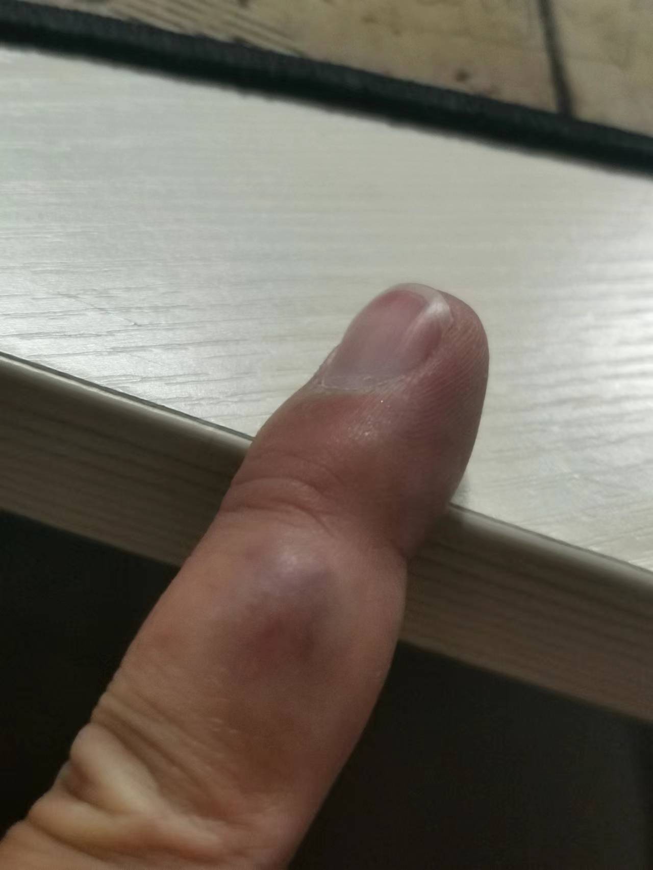 我的右手中指中间的位置长了一个暗红色的血包，不知道是什么症状