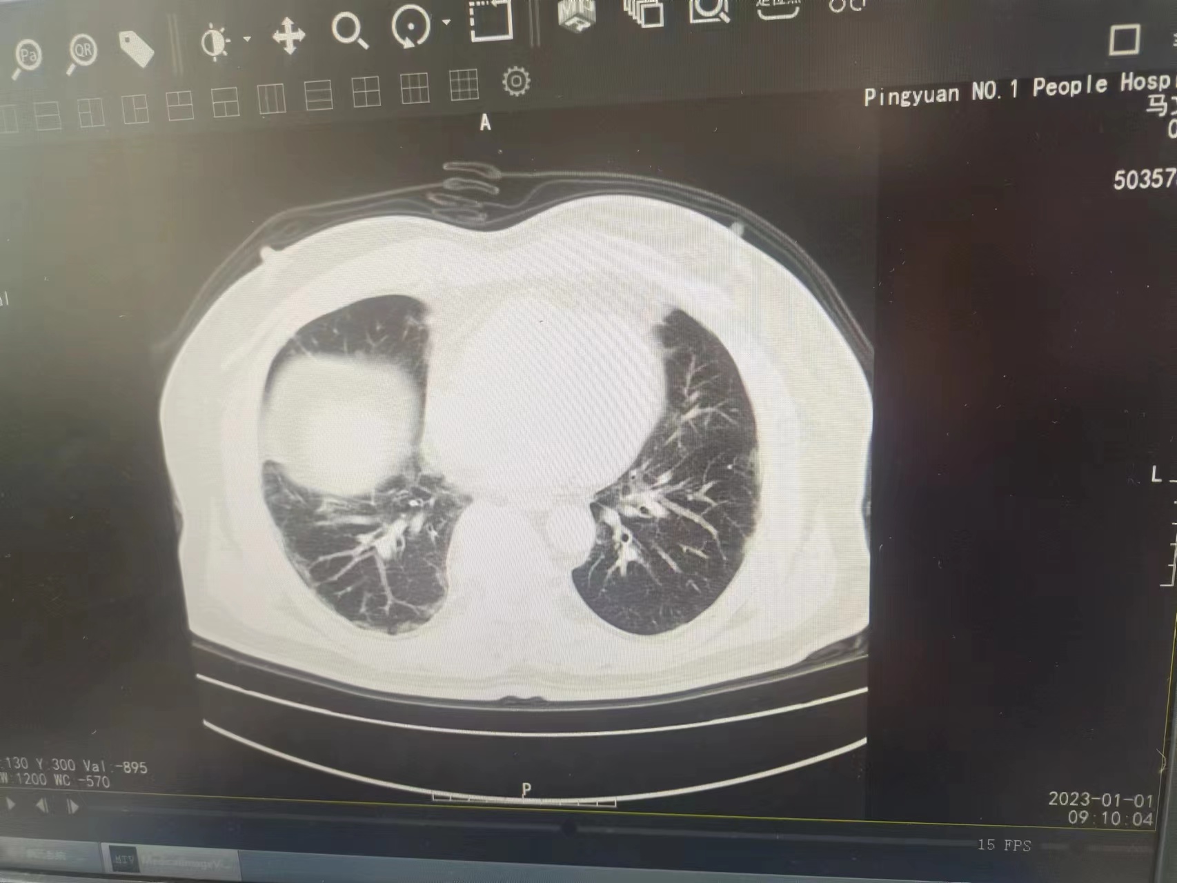 你好，病人咳嗽、有痰，厭食，1月1日做的的肺部CT，報告單未