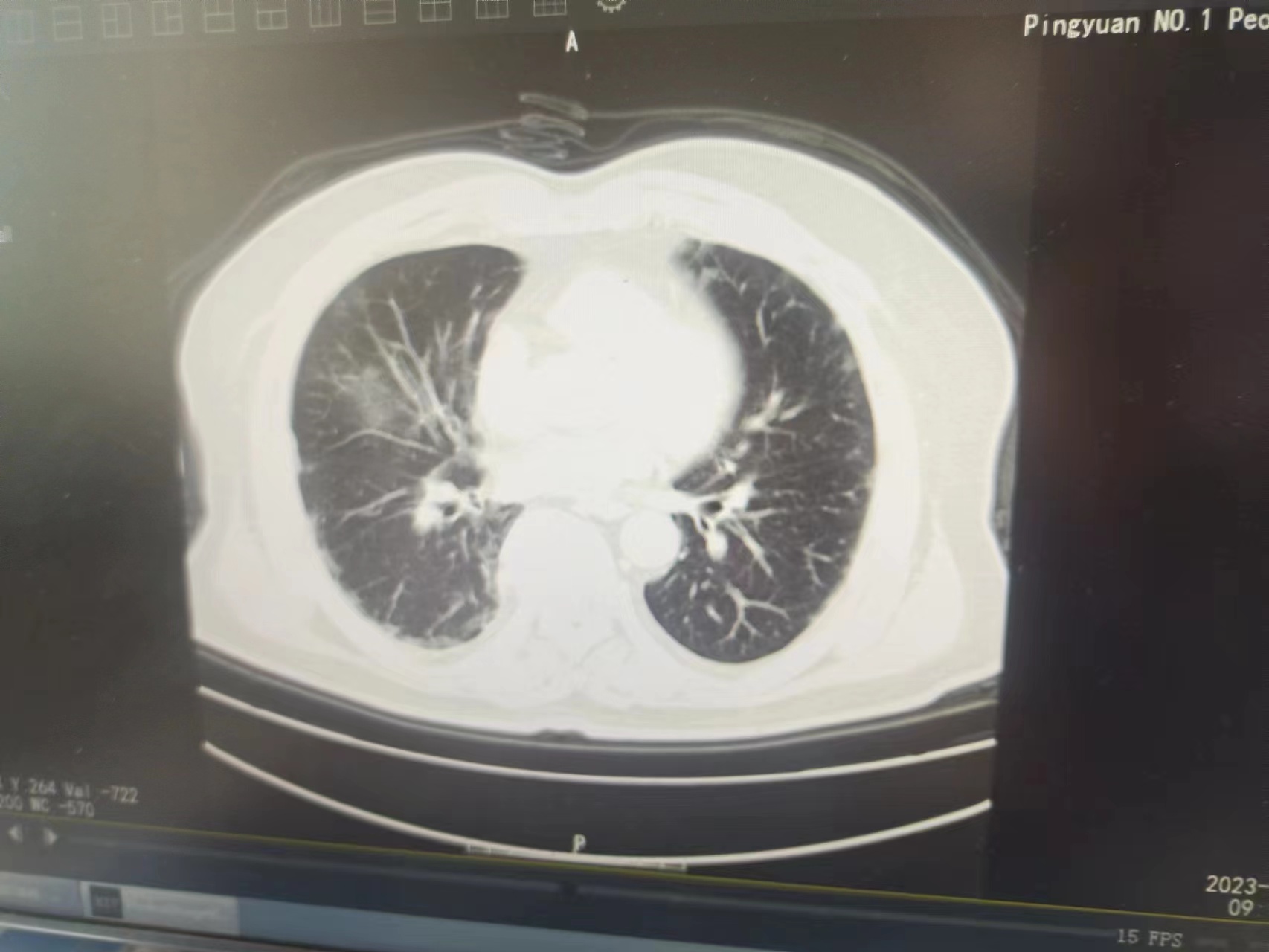 你好，病人咳嗽、有痰，厭食，1月1日做的的肺部CT，報告單未