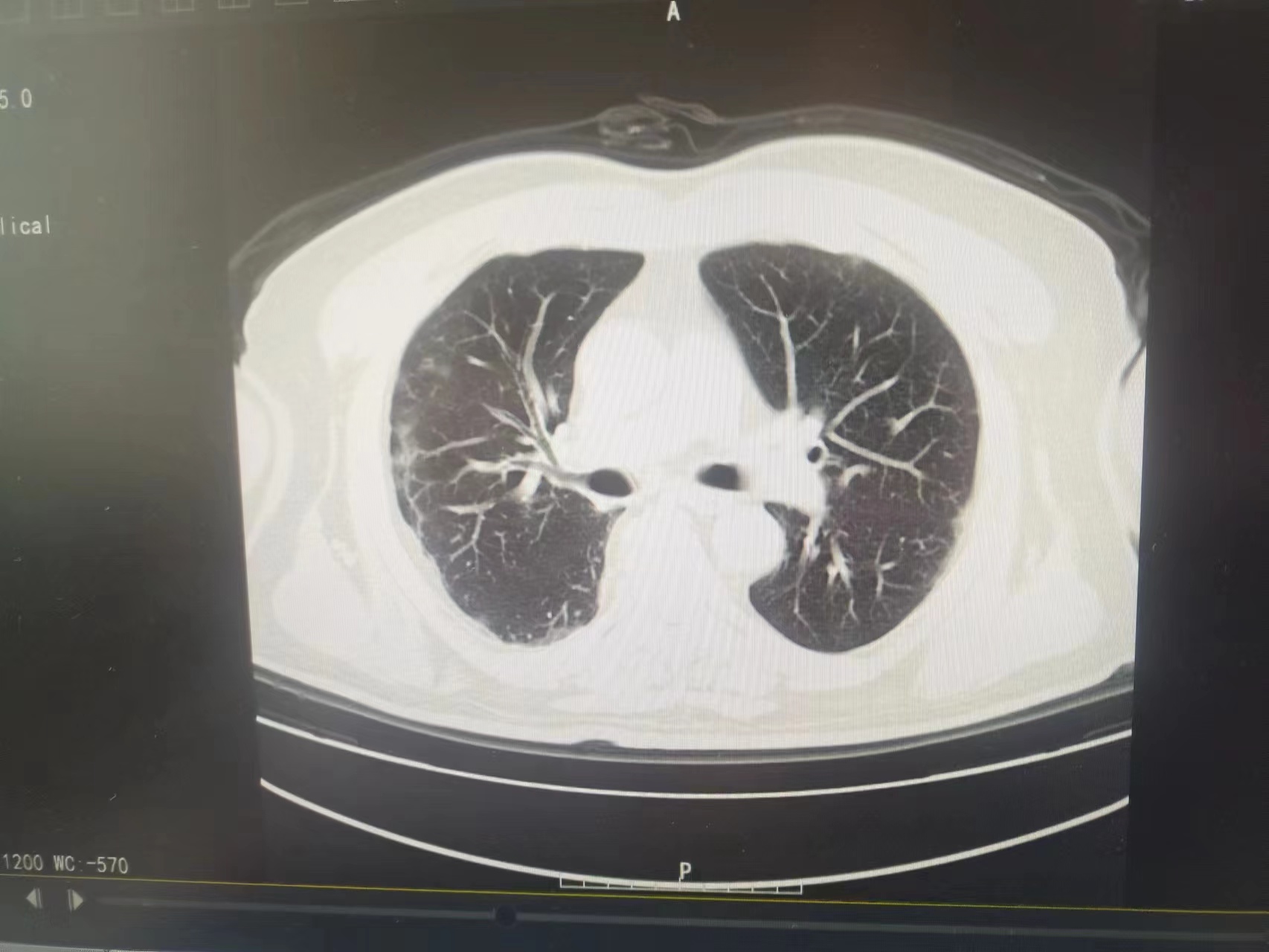 你好，病人咳嗽、有痰，厭食，1月1日做的的肺部CT，報告單未