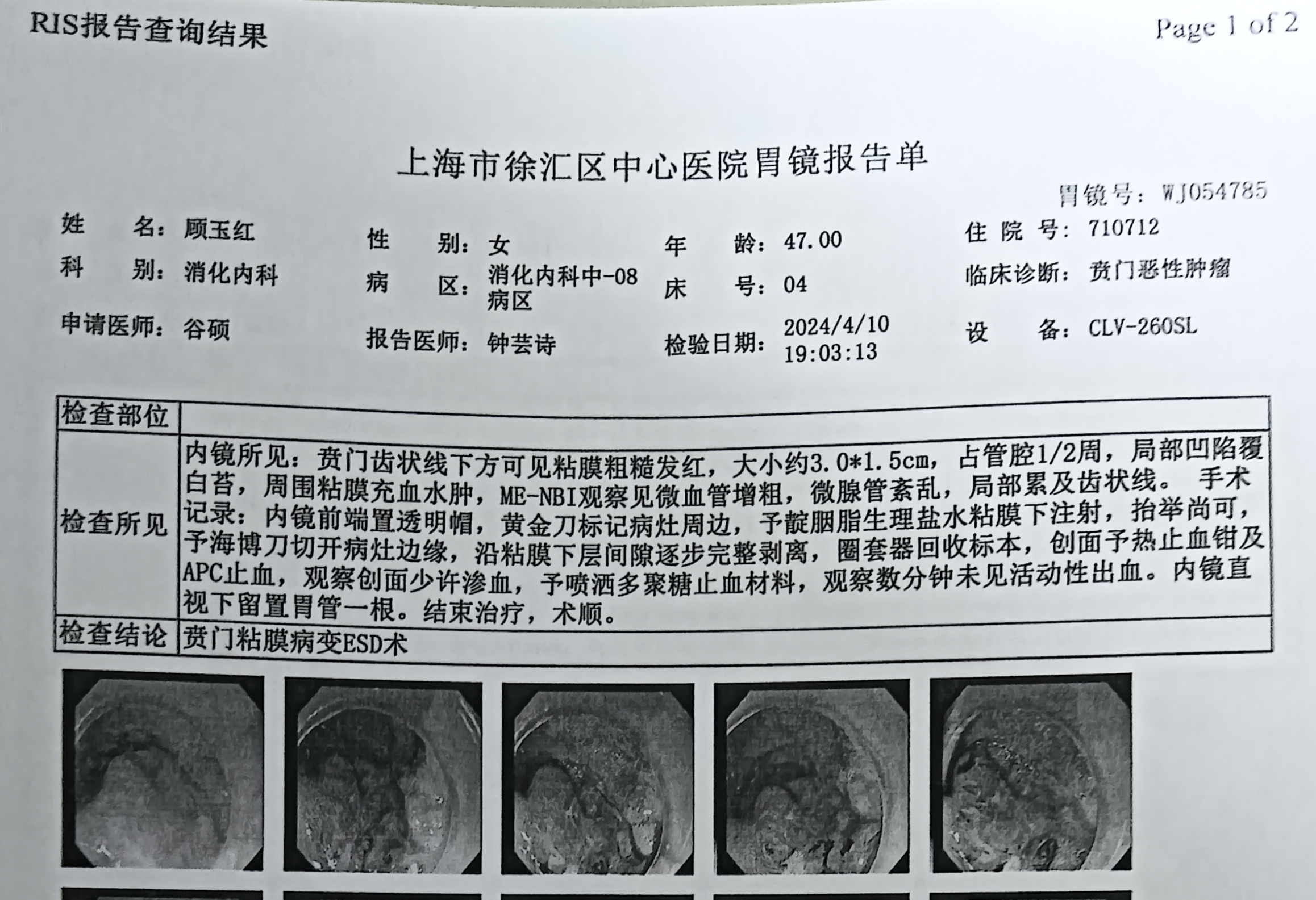 大約23年8月份哽噎，既往史:系統(tǒng)性紅斑狼瘡19年，激素治療