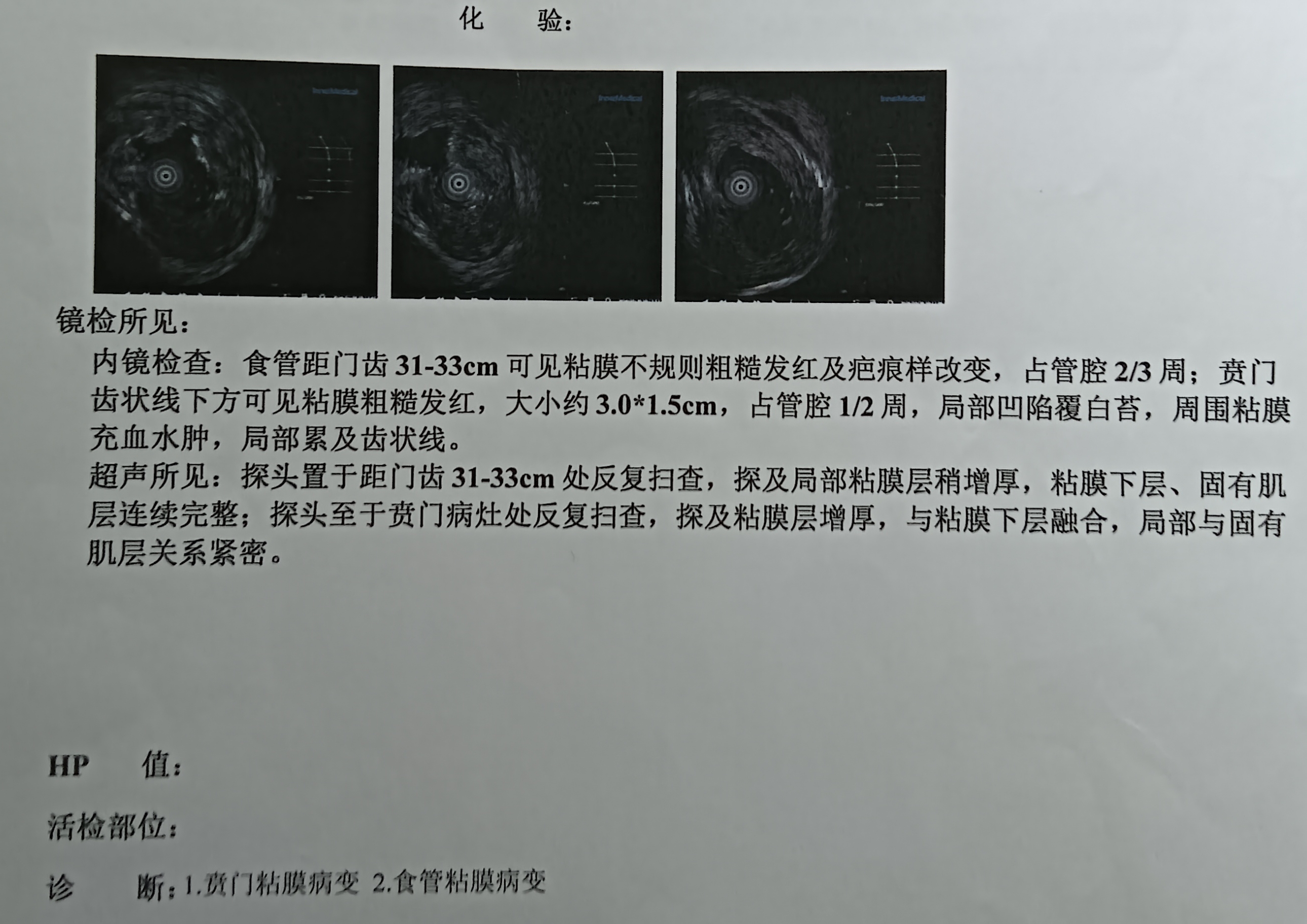 大約23年8月份哽噎，既往史:系統(tǒng)性紅斑狼瘡19年，激素治療