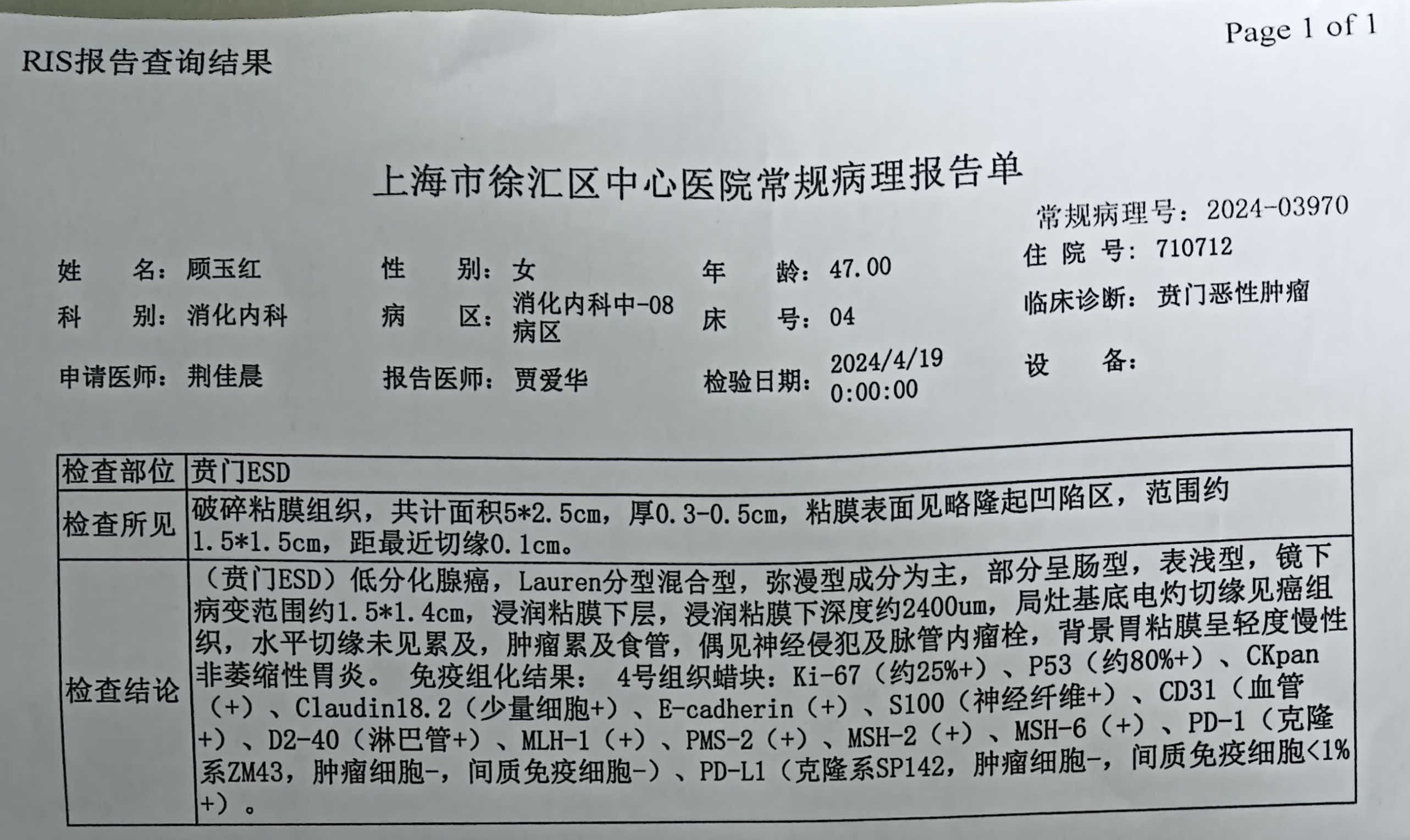 大約23年8月份哽噎，既往史:系統(tǒng)性紅斑狼瘡19年，激素治療