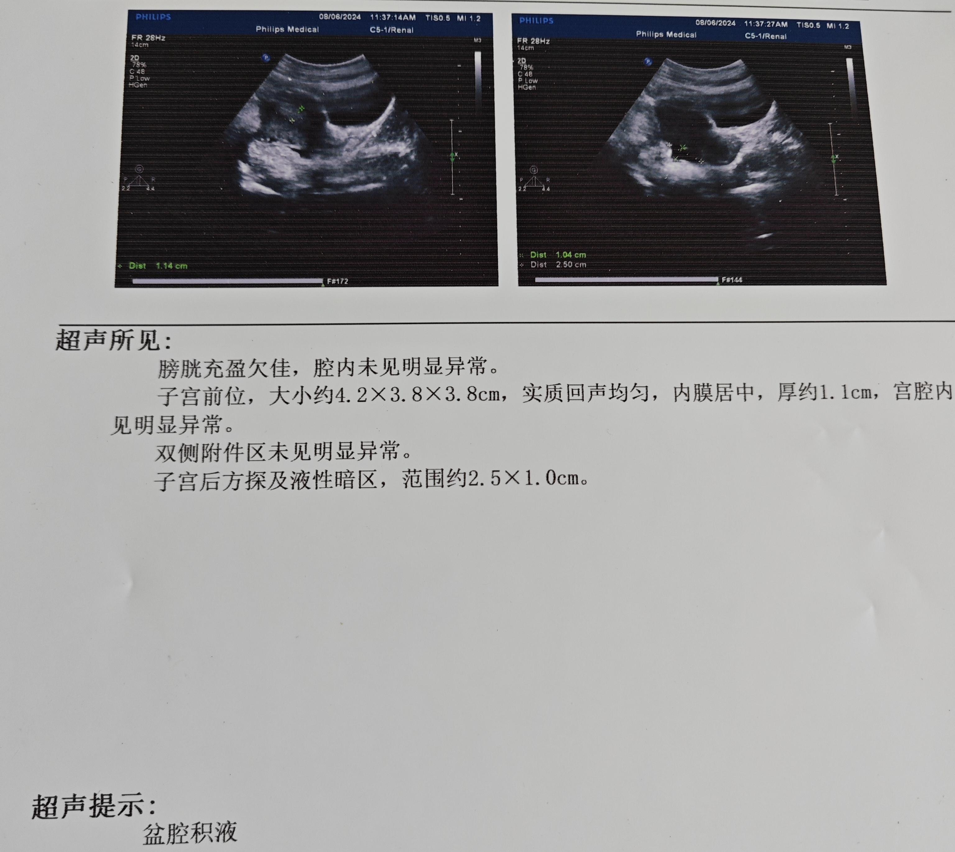 小腹左邊偶爾會(huì)疼，例假推遲15天，去醫(yī)院做了彩超，請(qǐng)問(wèn)是盆腔