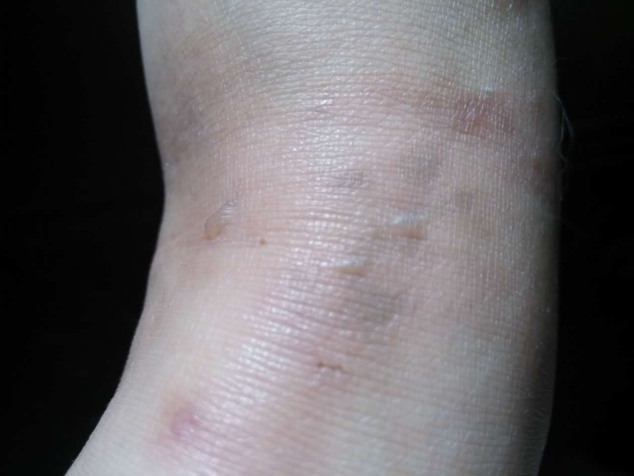 蜈蚣脚疤痕图片