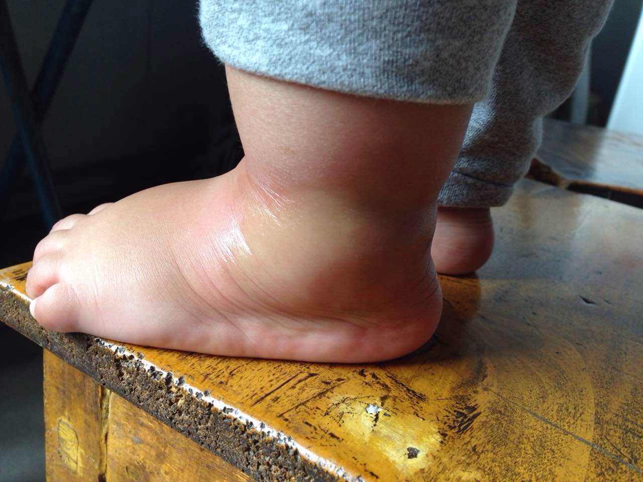 孩子早晨起来突然发现左脚踝肿了个大包孩子说不舒服不红