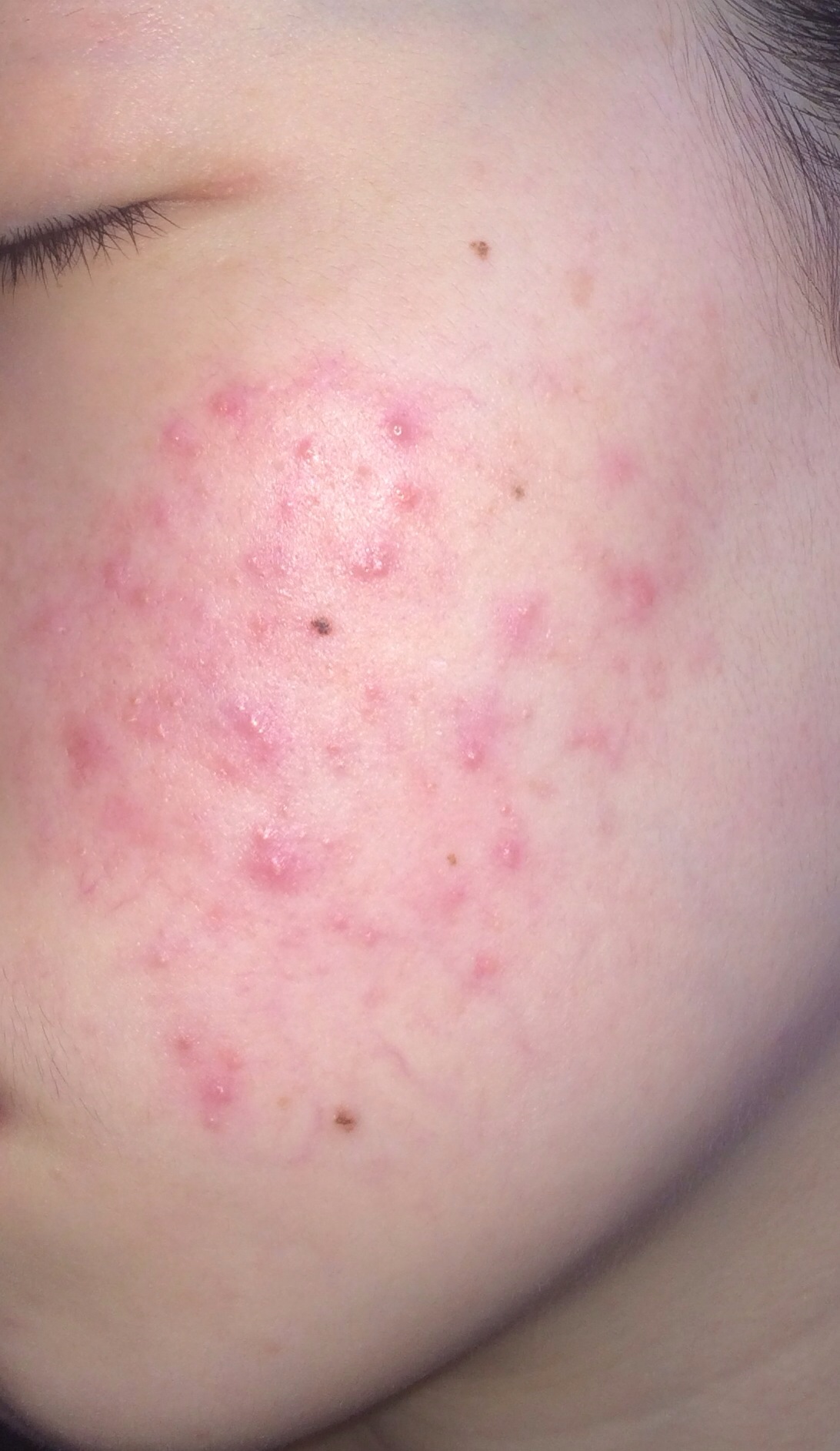 脸颊痘痘红红的,是微起的痘痘,摸上去不光滑,有半年的时间了