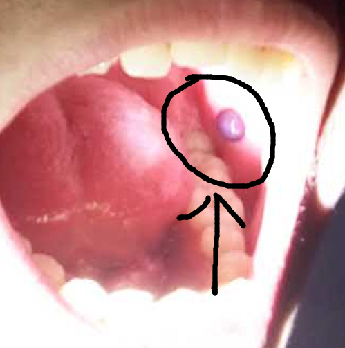 口腔皮脂腺图片