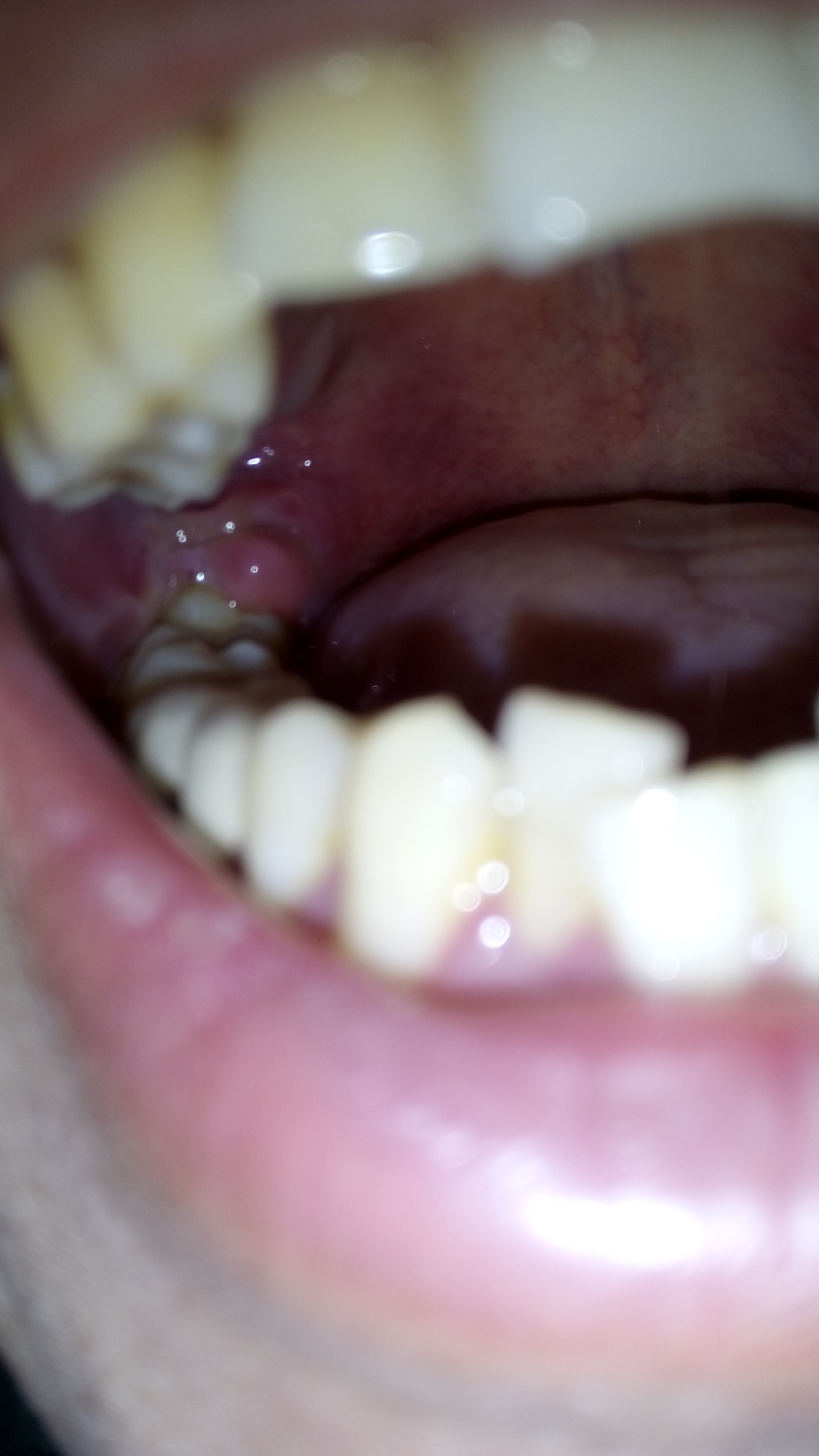 槽牙后面的牙肉肿图片图片