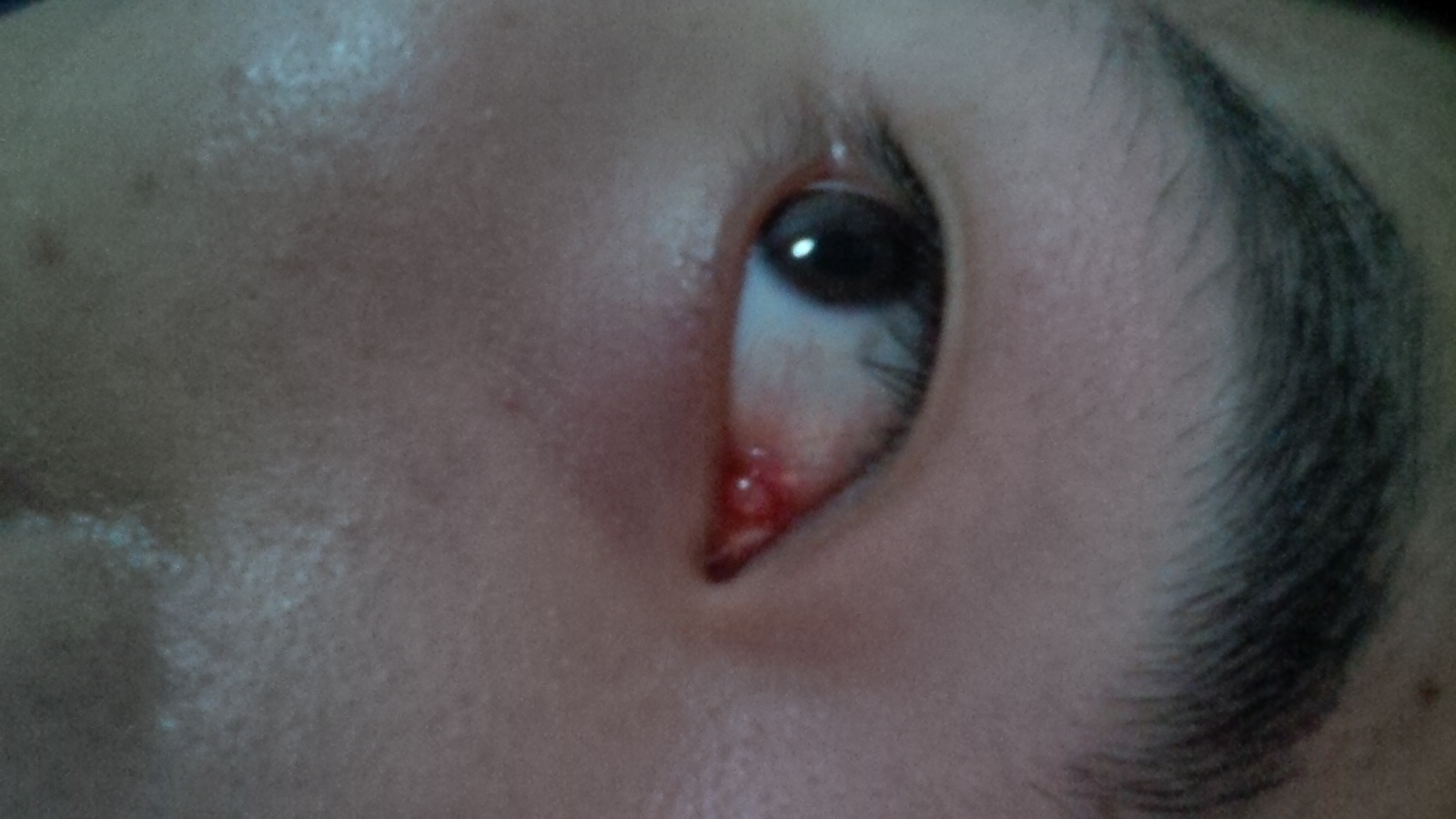 医生我的眼角长了一个疙瘩挺红的里边不是浓好像也不是水泡
