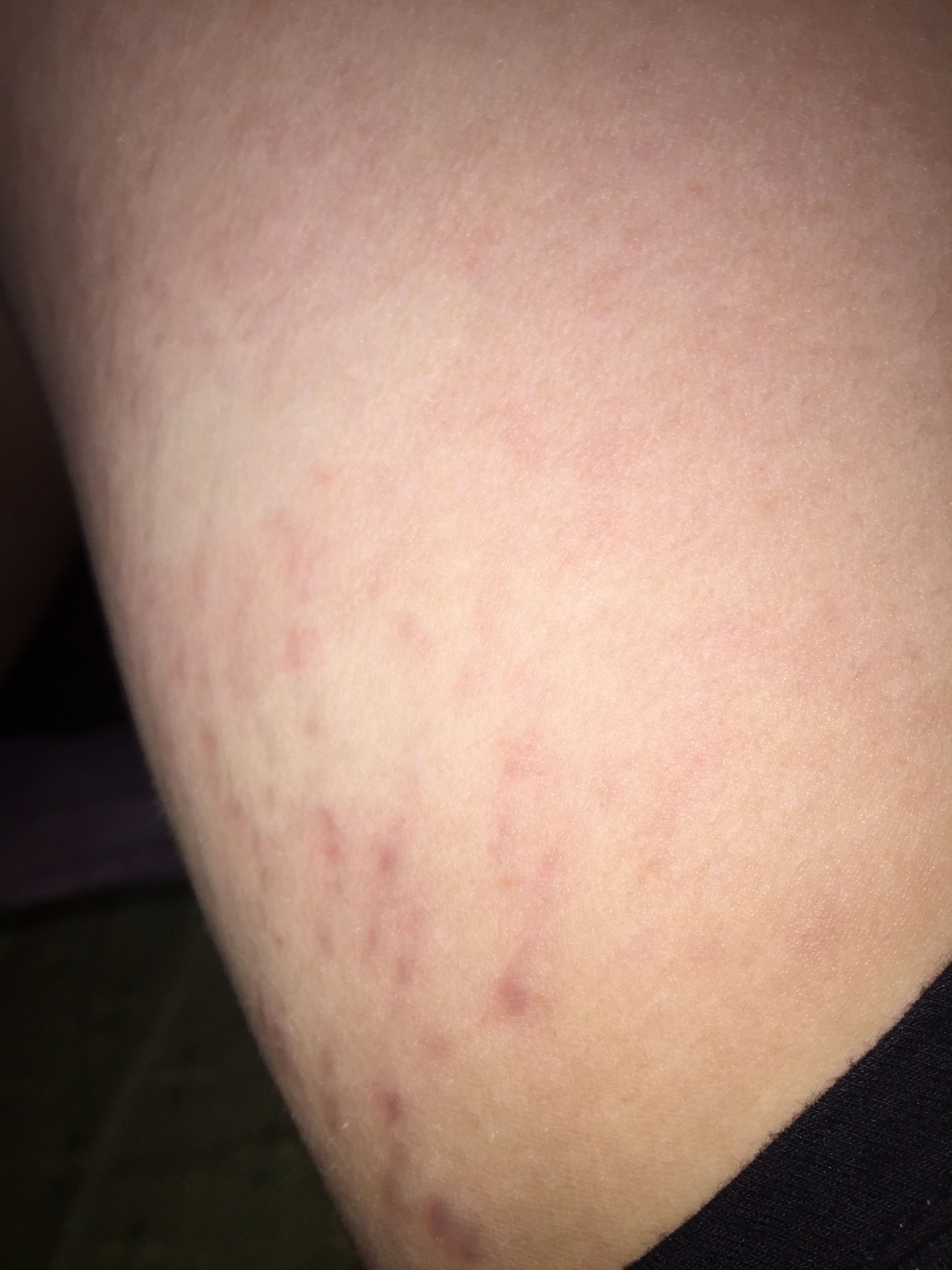 大腿内侧有些紫红色的小红斑是什么呢不痛不痒就是大腿内侧双