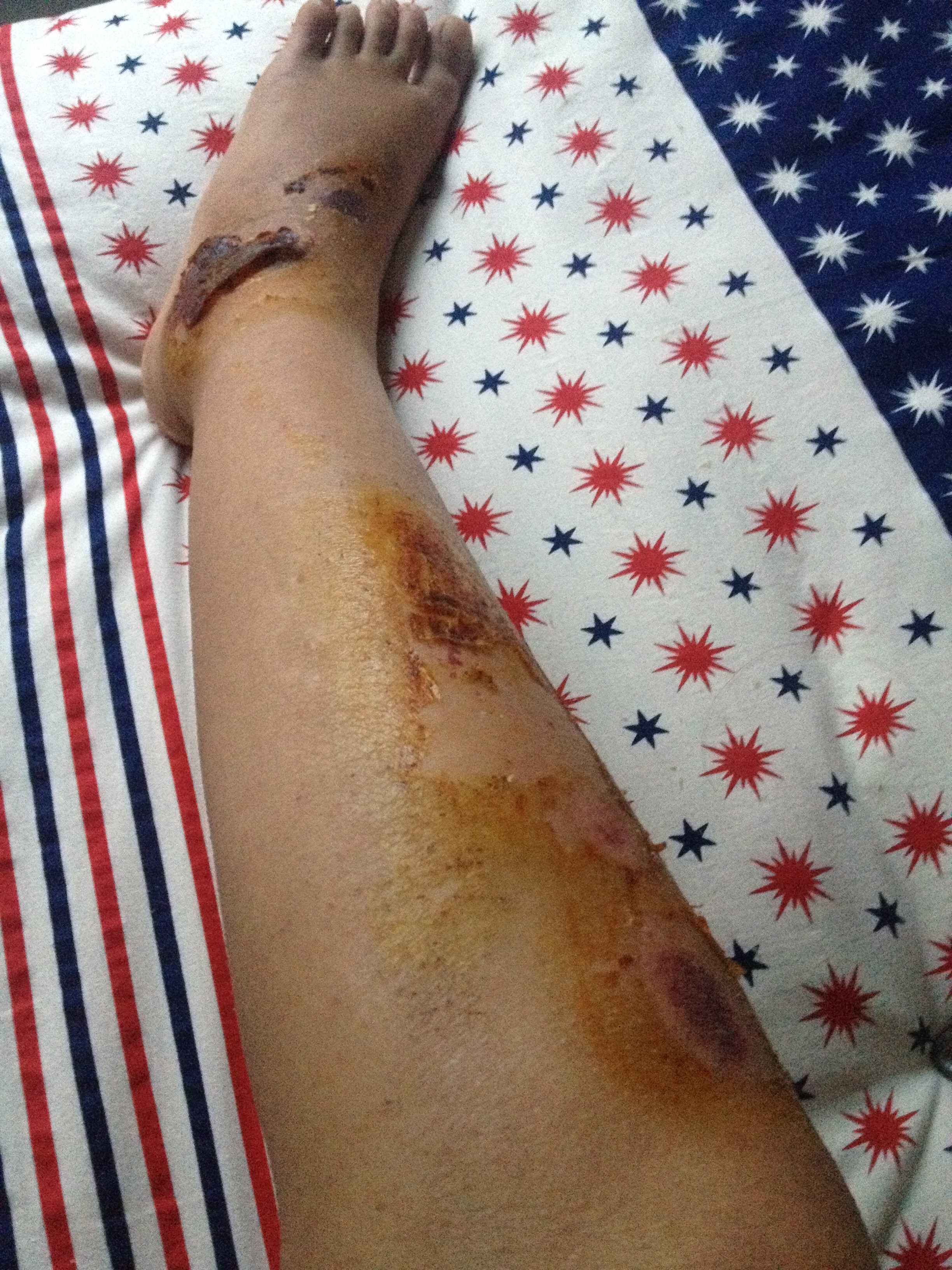 腿被电瓶车撞肿的图片图片