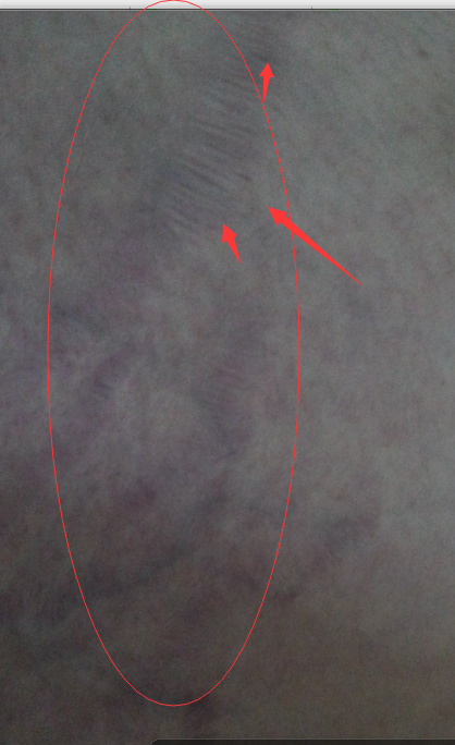 冬天大腿内侧网状瘀紫图片