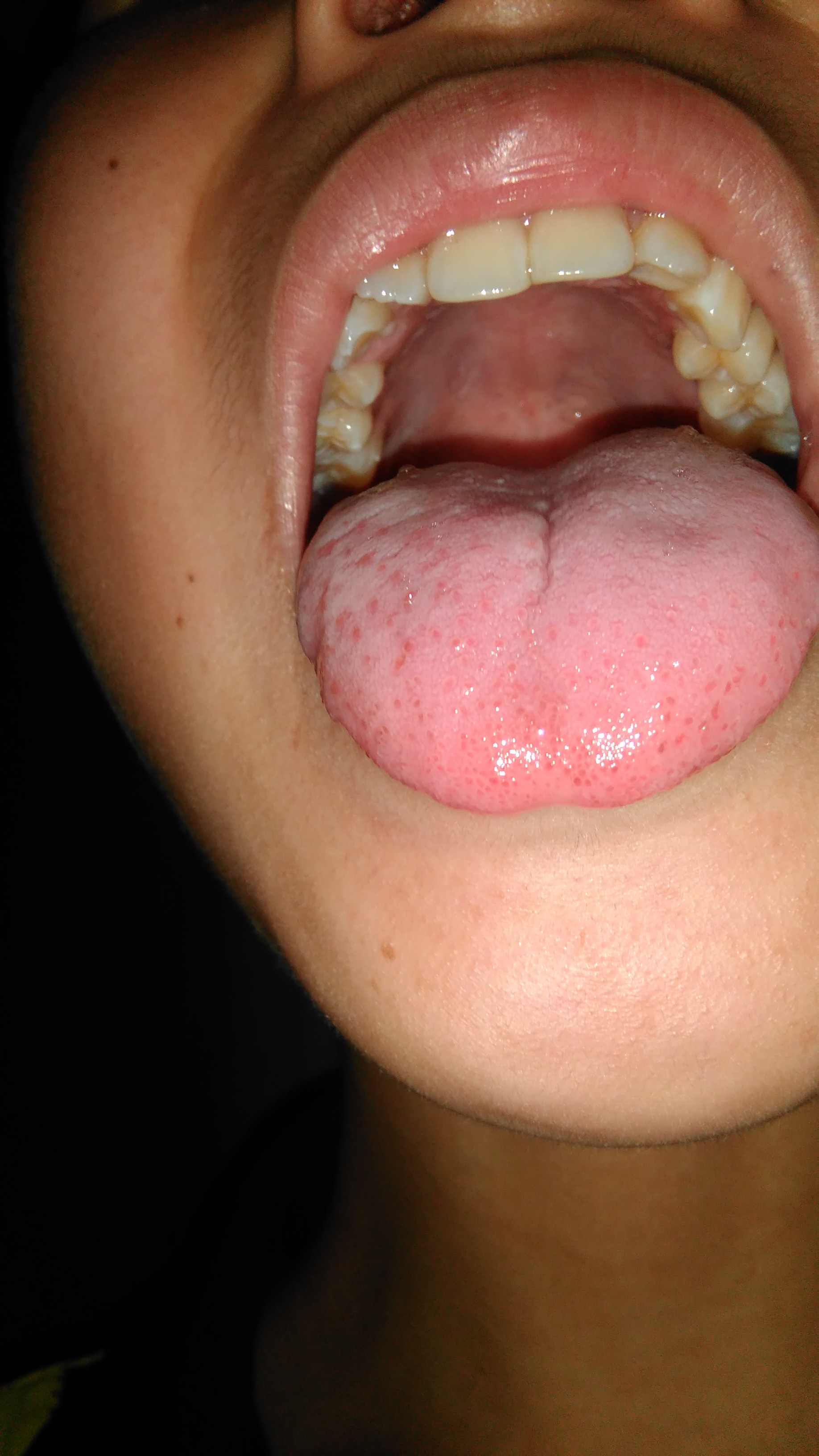 舌头痛咽口水也痛舌头尖有很多红色的点点