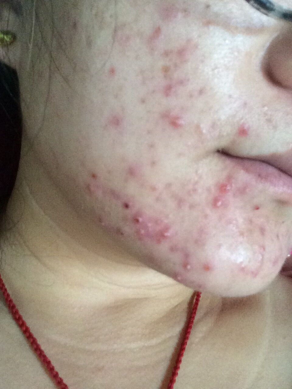 最近一个月了脸上下巴张痘痘2而且是一片洪红的而且痒有多