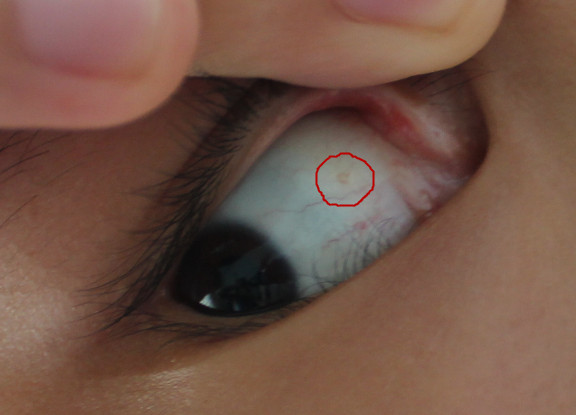 白眼球上长了一颗小疙瘩(如下图),导致眼睛不适,发痒
