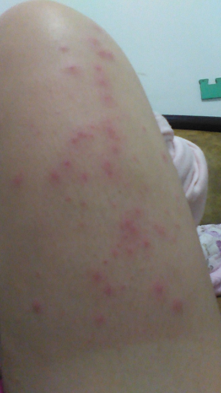 肩膀晒伤起了很多鸡皮疙瘩(胳膊被晒伤了起很多疙瘩很痒)