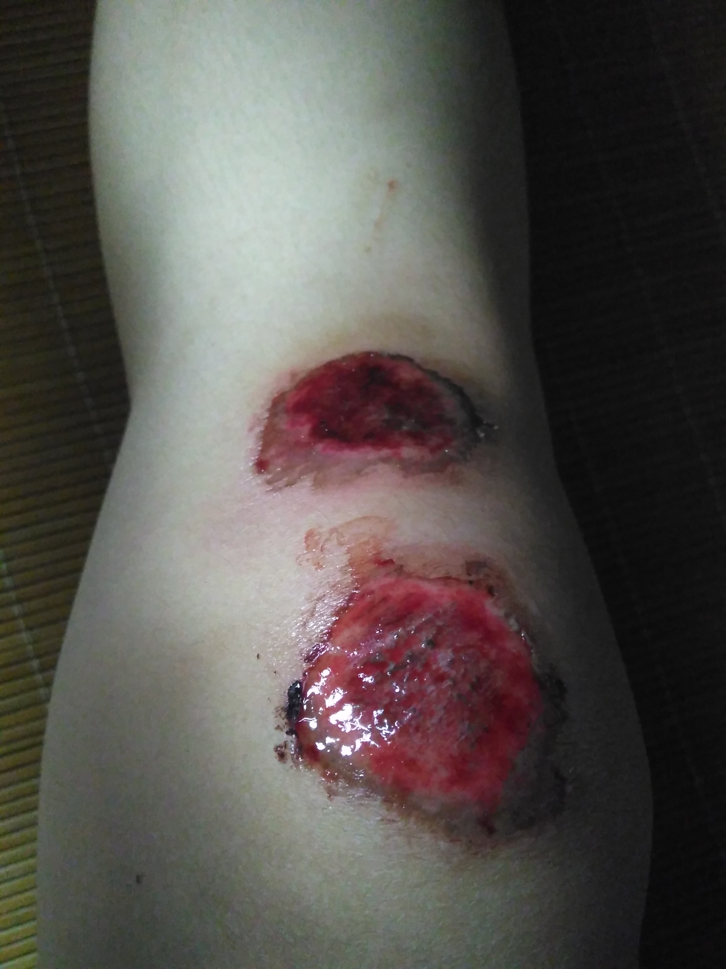 骑车摔倒伤口流血图片图片