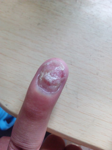 左手无名指指甲凹凸不平指甲变脆在凹凸不平的地方有白色斑块指甲