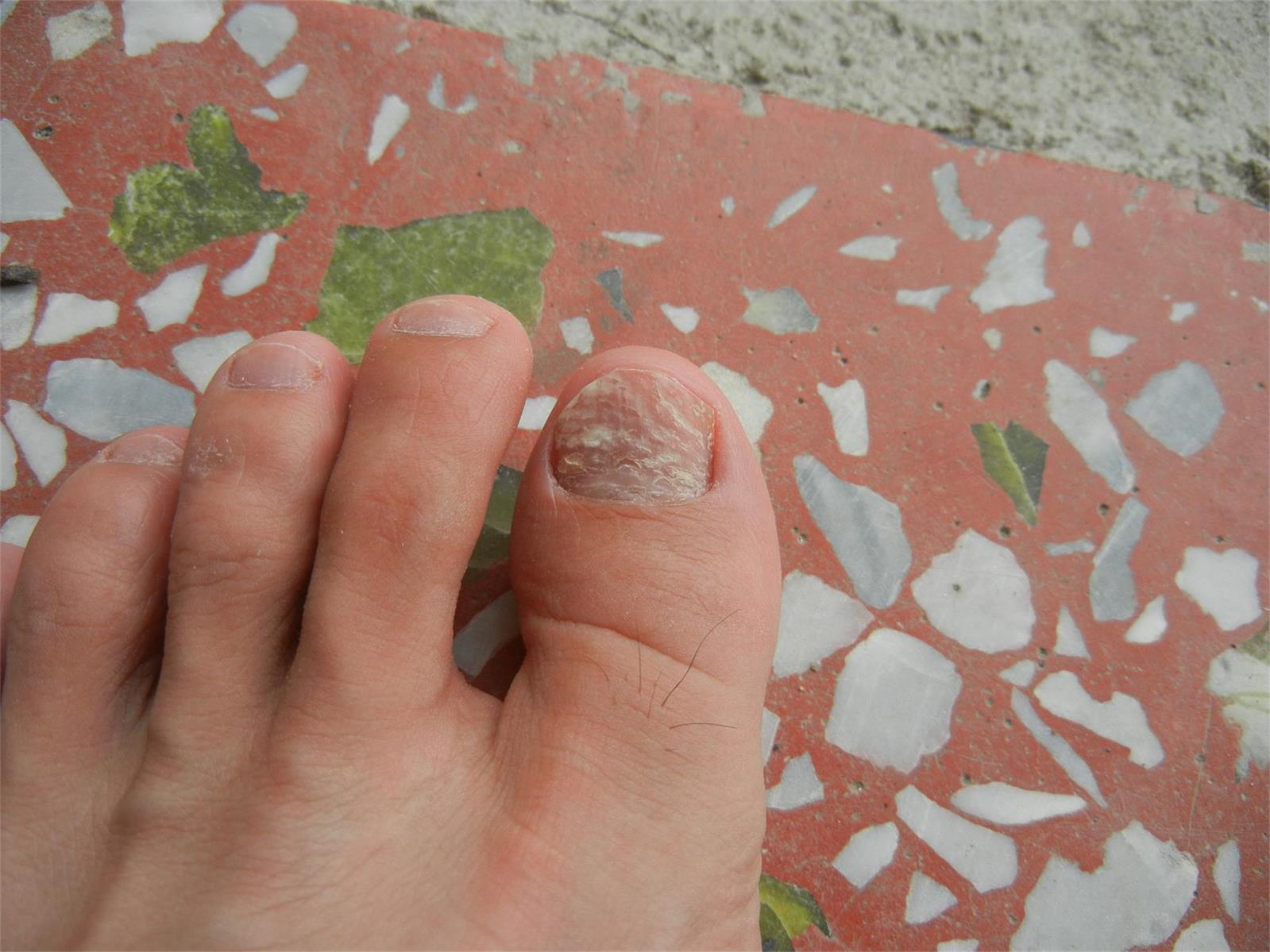 我的左脚大拇指指甲凹凸不平并且有白斑已经有半年了其他脚