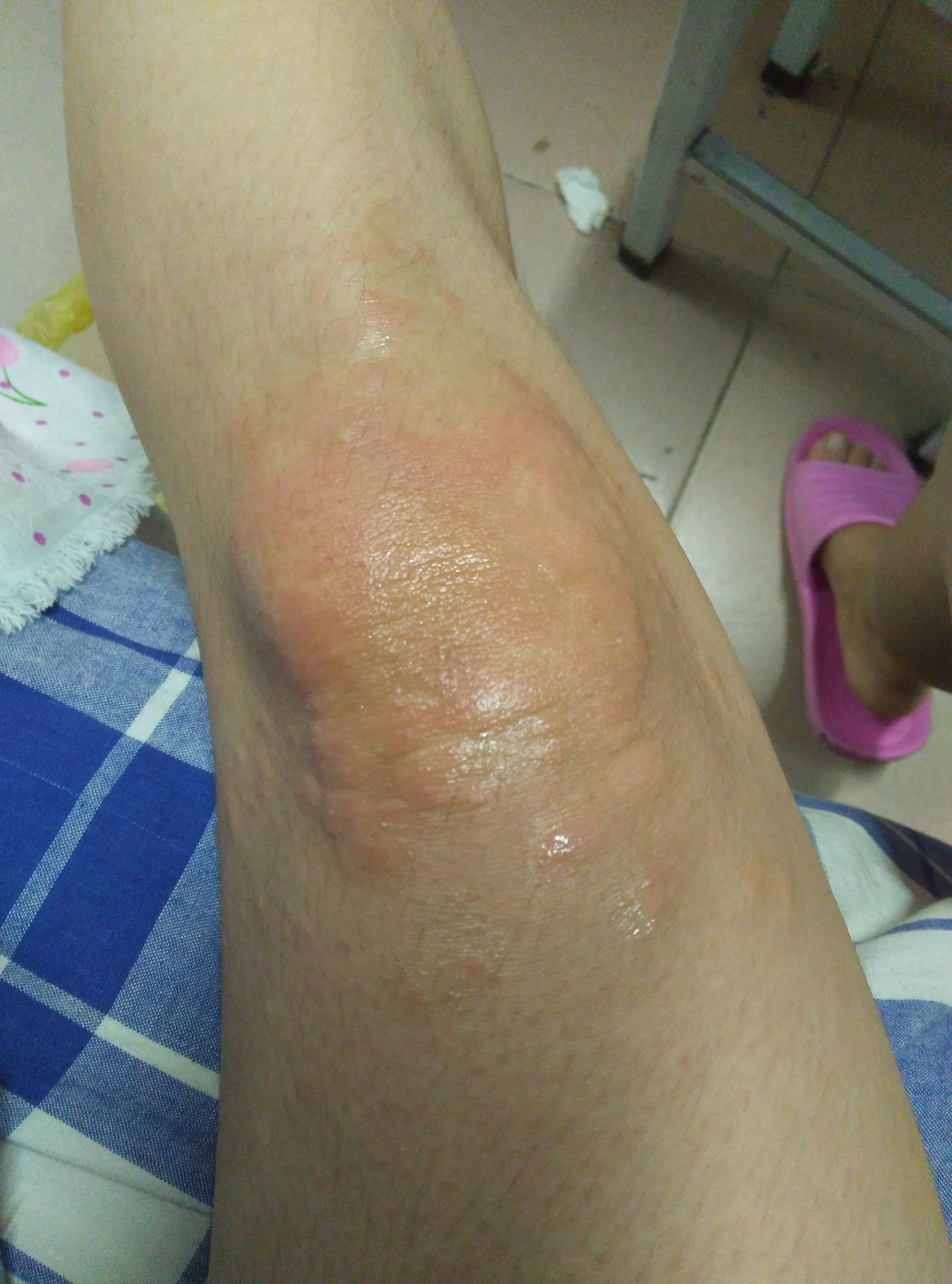 膝盖过敏性皮炎图片图片