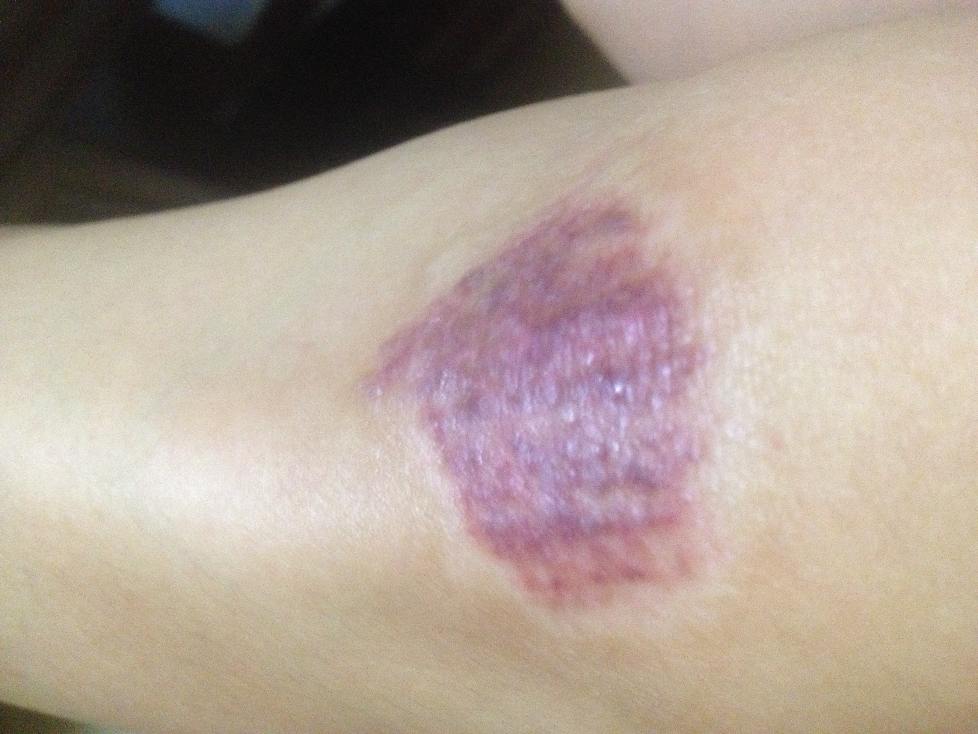 上个月骑车摔结巴成这样了里面发紫痒痒的严重么